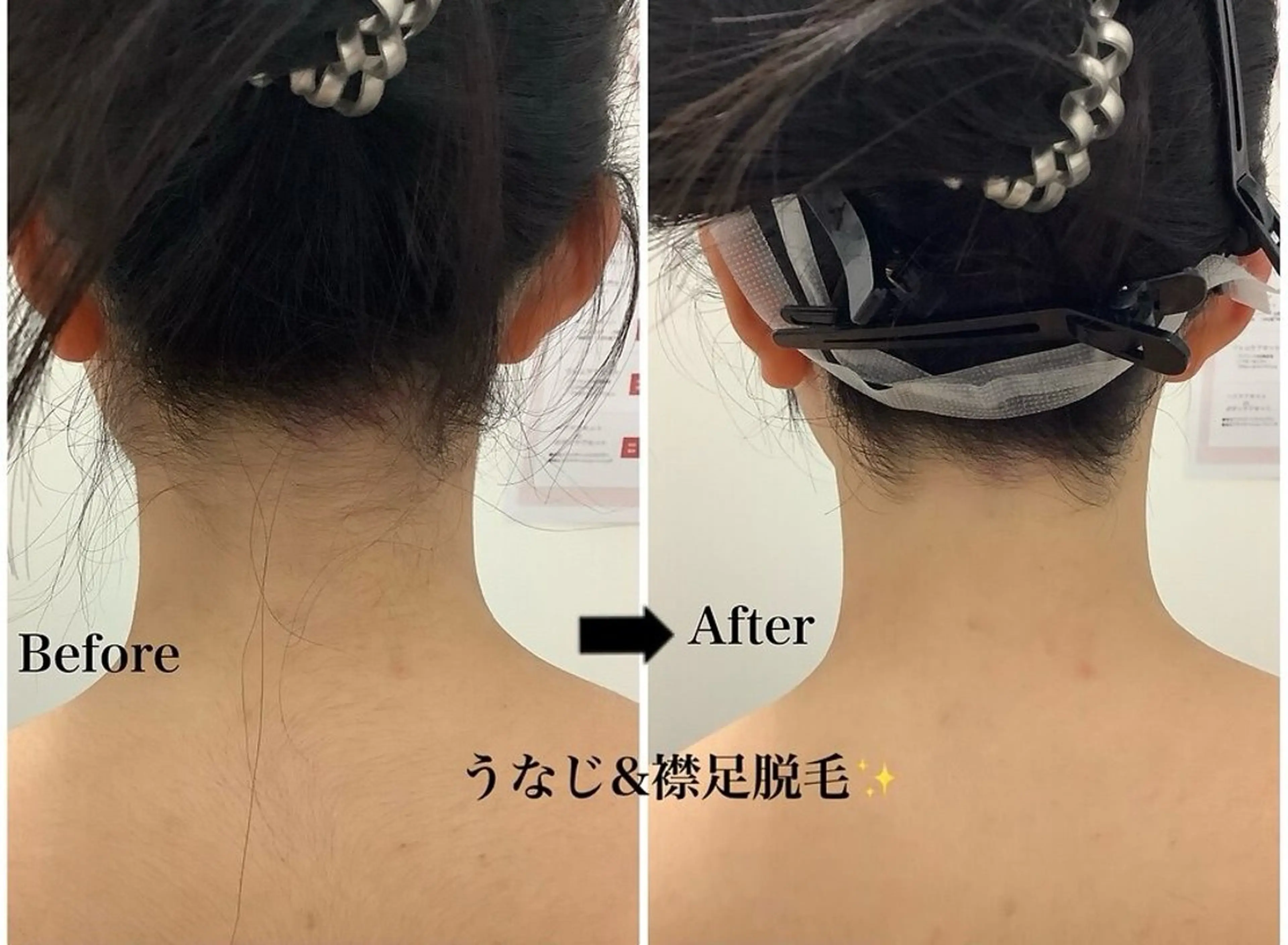 脱毛 韓国肌管理×毛穴 改善専門🤍nanaのエステ・リラクイメージ