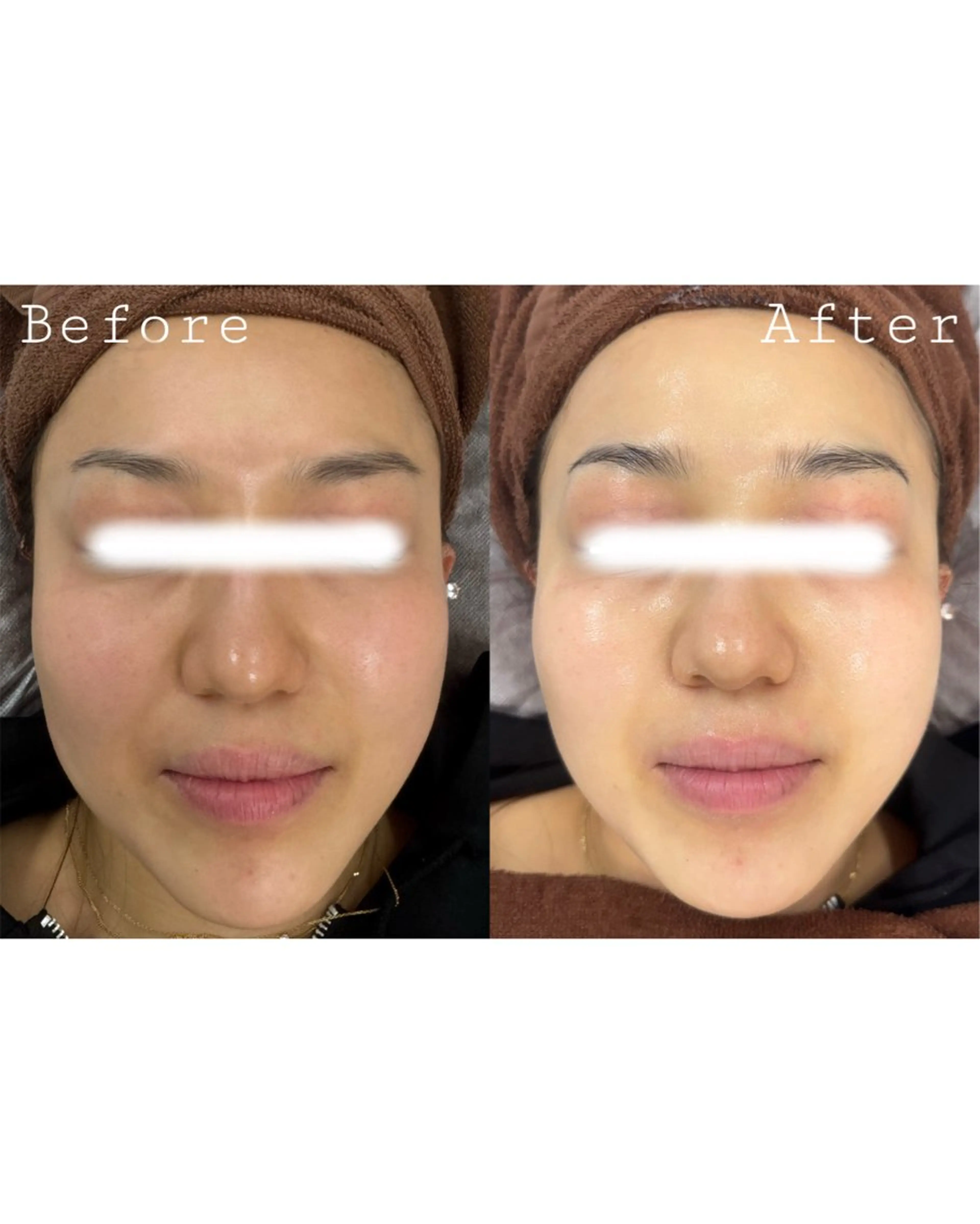 ✨【透明感UP美肌】シミ・くすみ・たるみ改善フェイシャルコース✨の写真