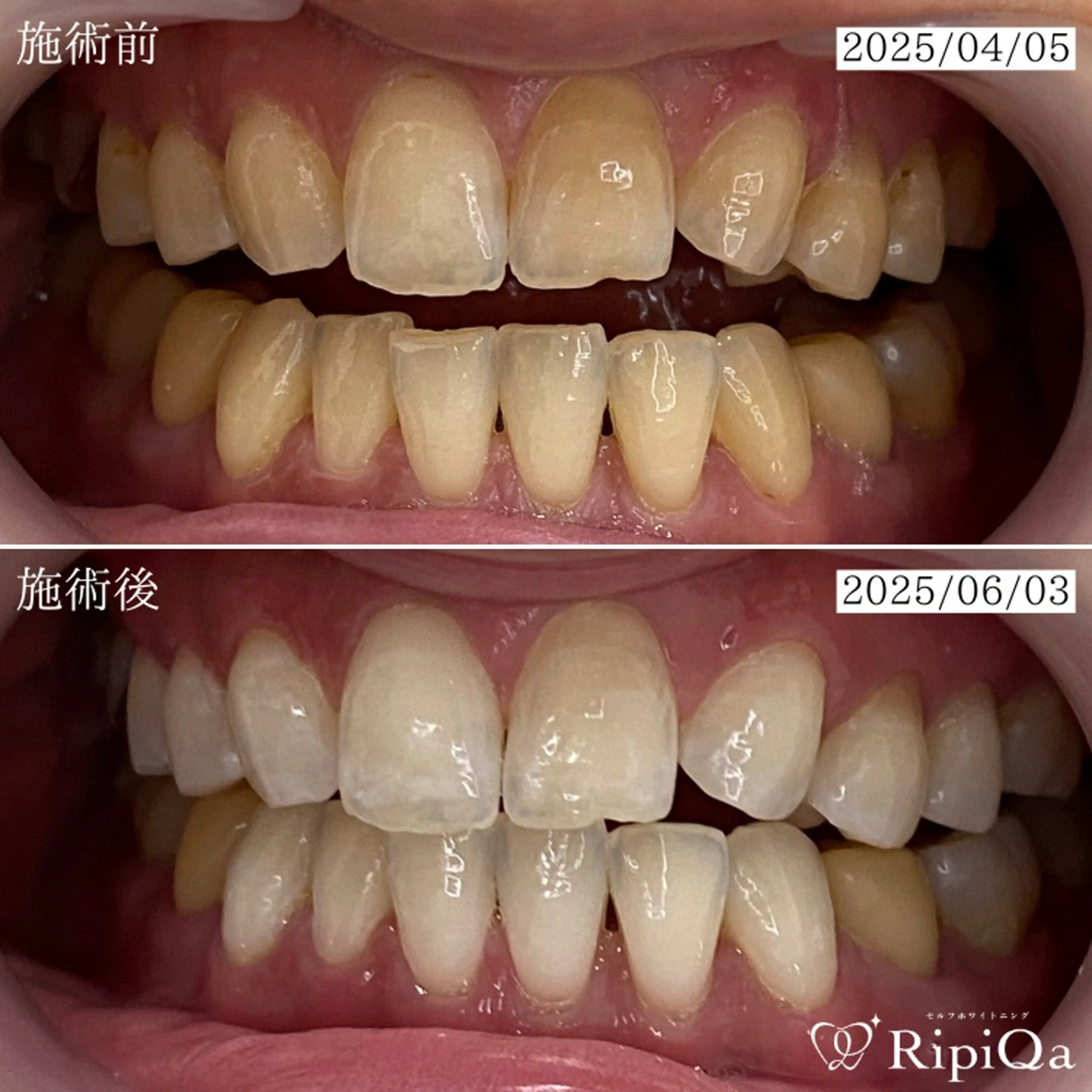 セルフホワイトニング RipiQaのその他イメージ