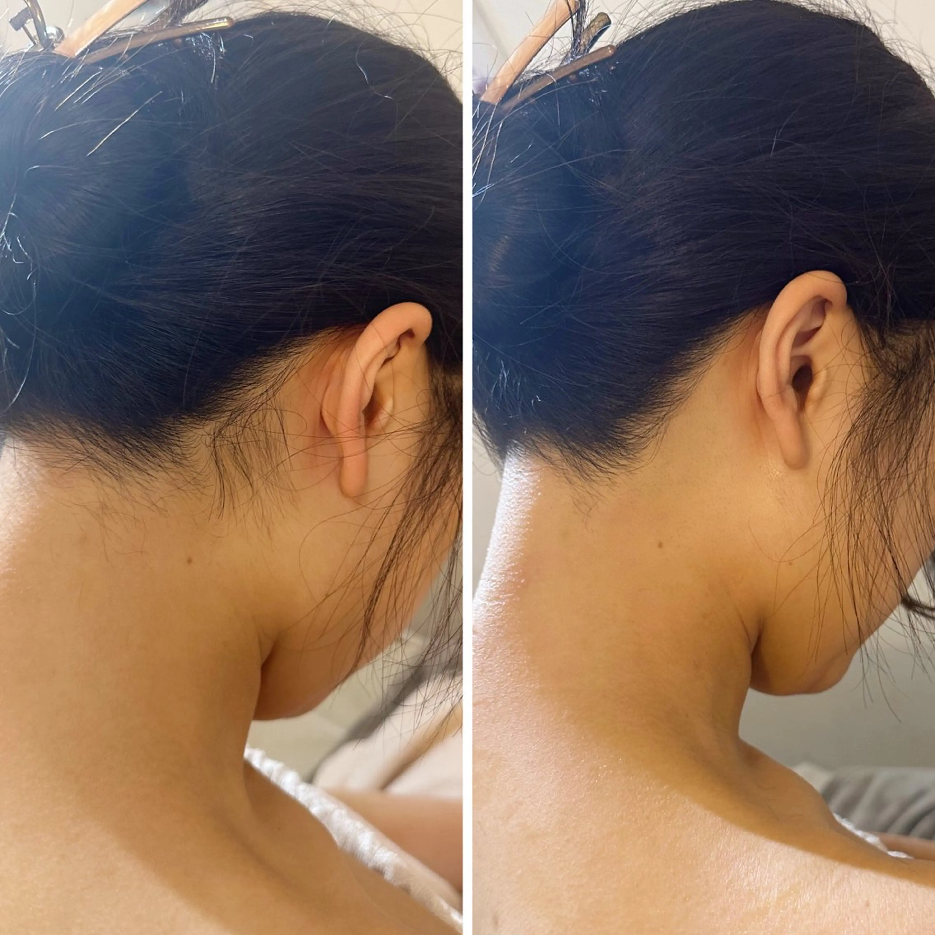 脱毛 うなじ脱毛/美肌脱毛 LABELのエステ・リラクイメージ