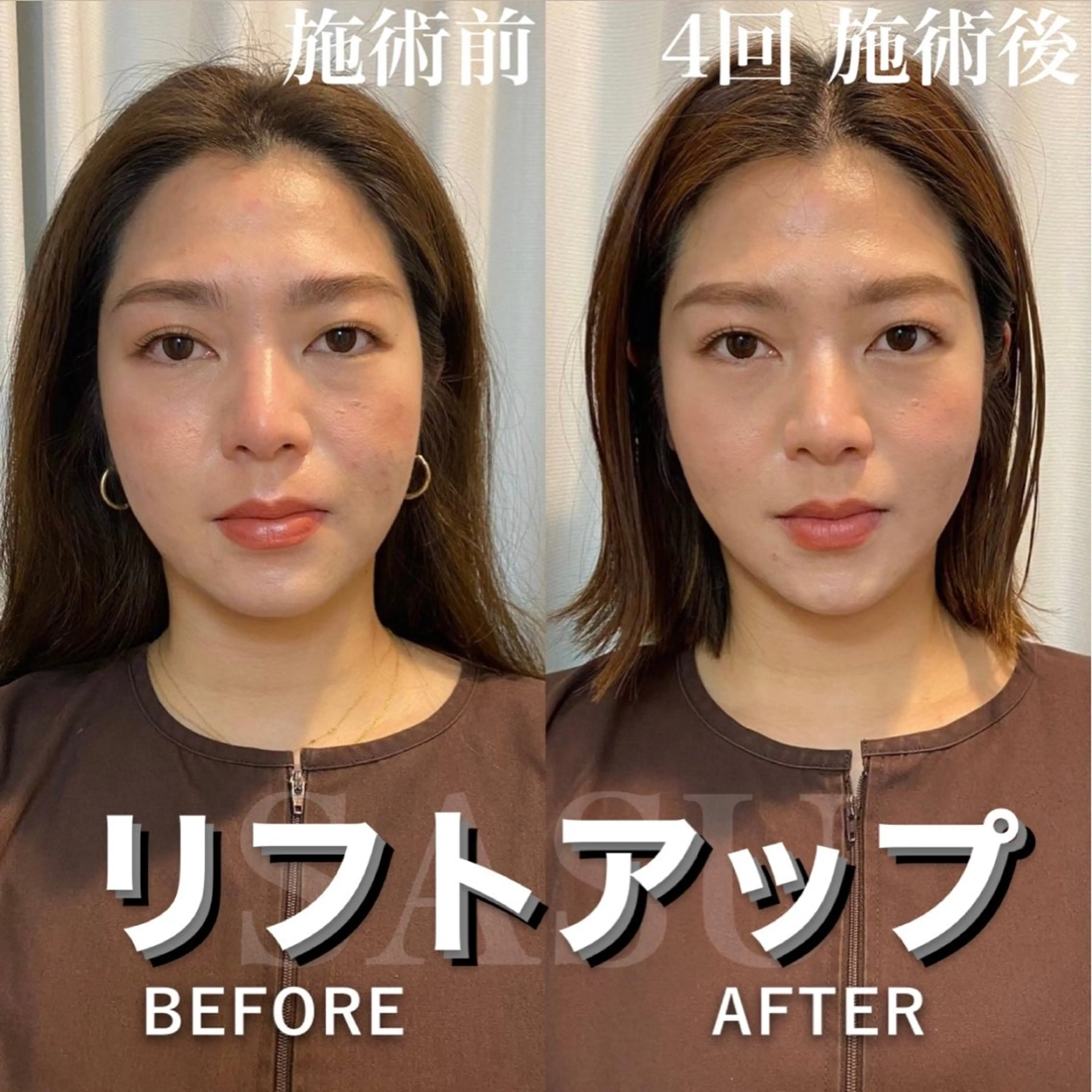 その他 鍼灸×ハーブピーリングサロンSASU所属・石井 稚乃のその他イメージ