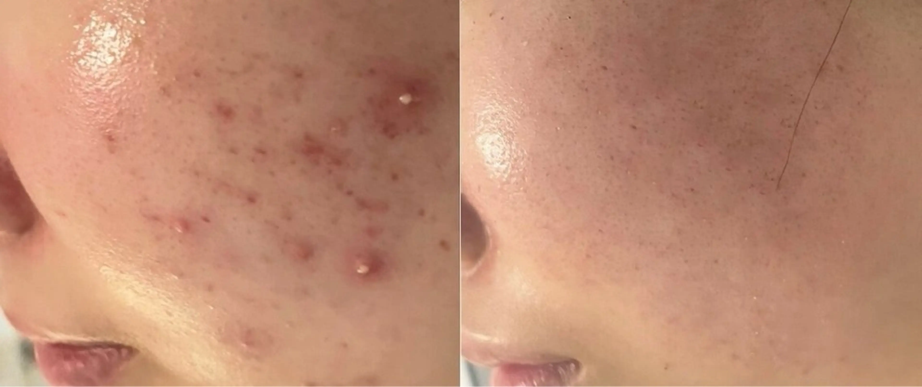 🍀リピーター様🍀【剥離なしハーブピーリング】ミニモからご予約２回目​〜​リピーター様限定価格🌷の写真