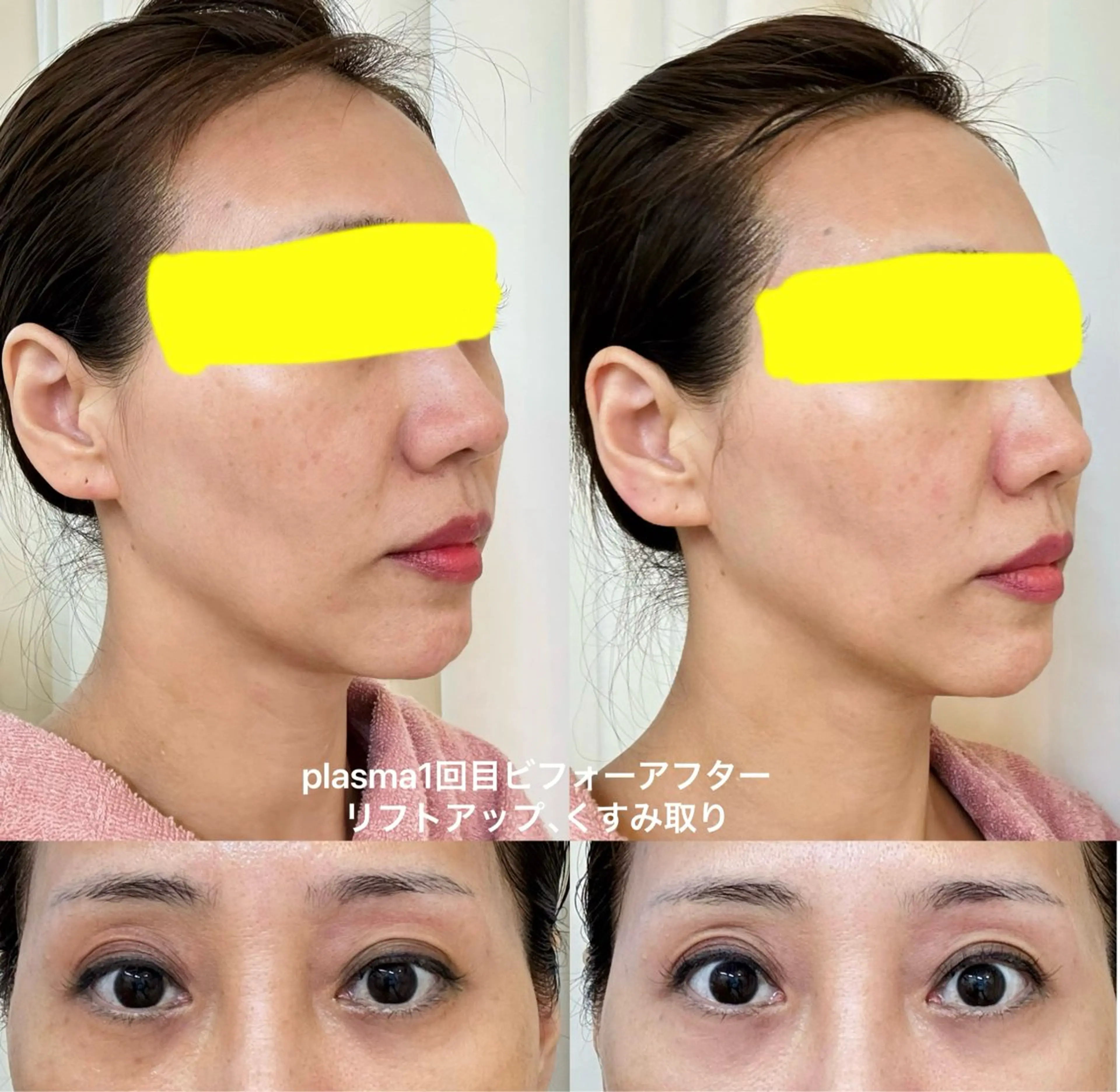 ❣️ミニモ特別価格❣️最新2in1プラズマシャワー:リフトアップ・小顔、くすみ解消クマ改善☆艶うる肌70分❣️の写真