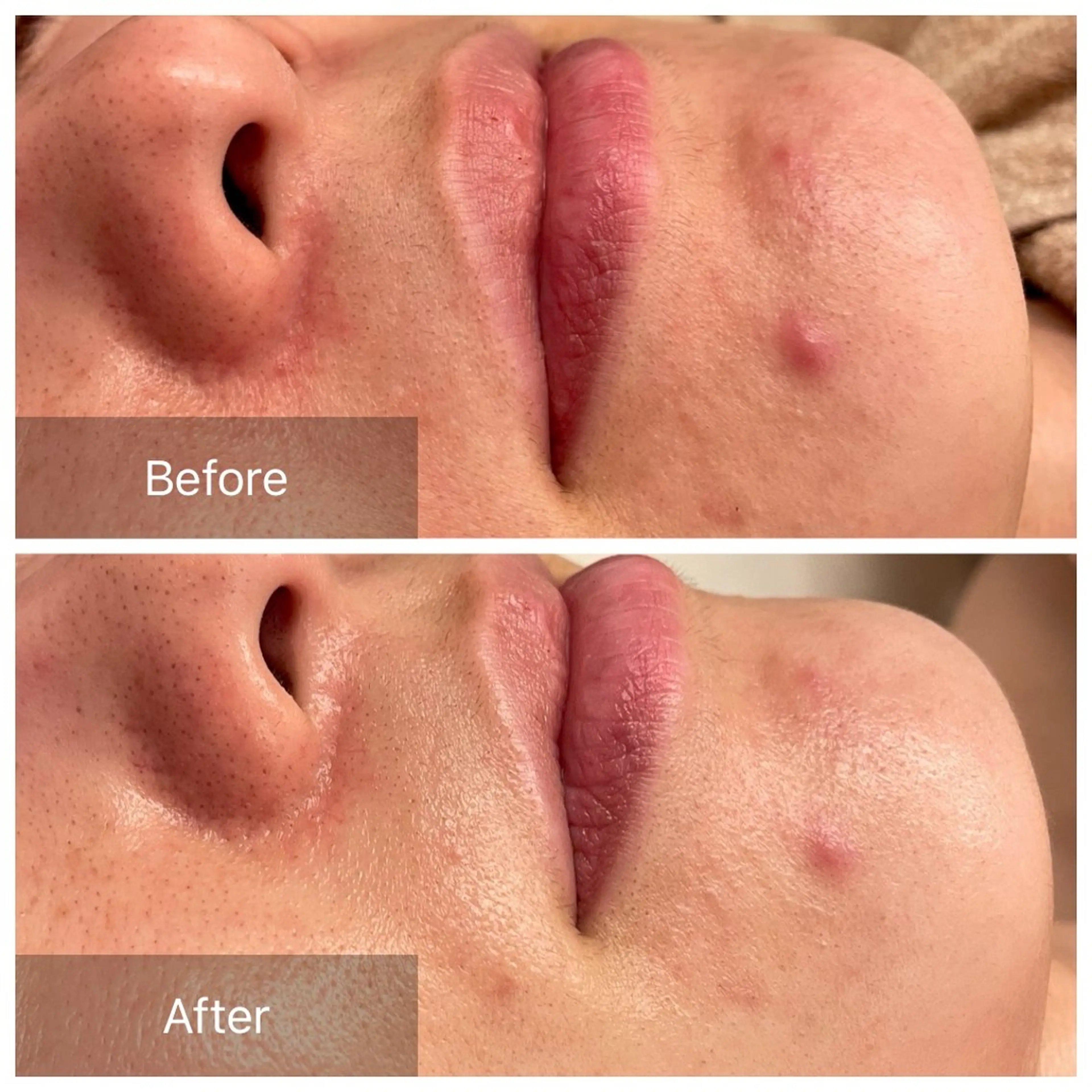 ハーブピーリング 肌再生ピーリング/のエステ・リラクイメージ