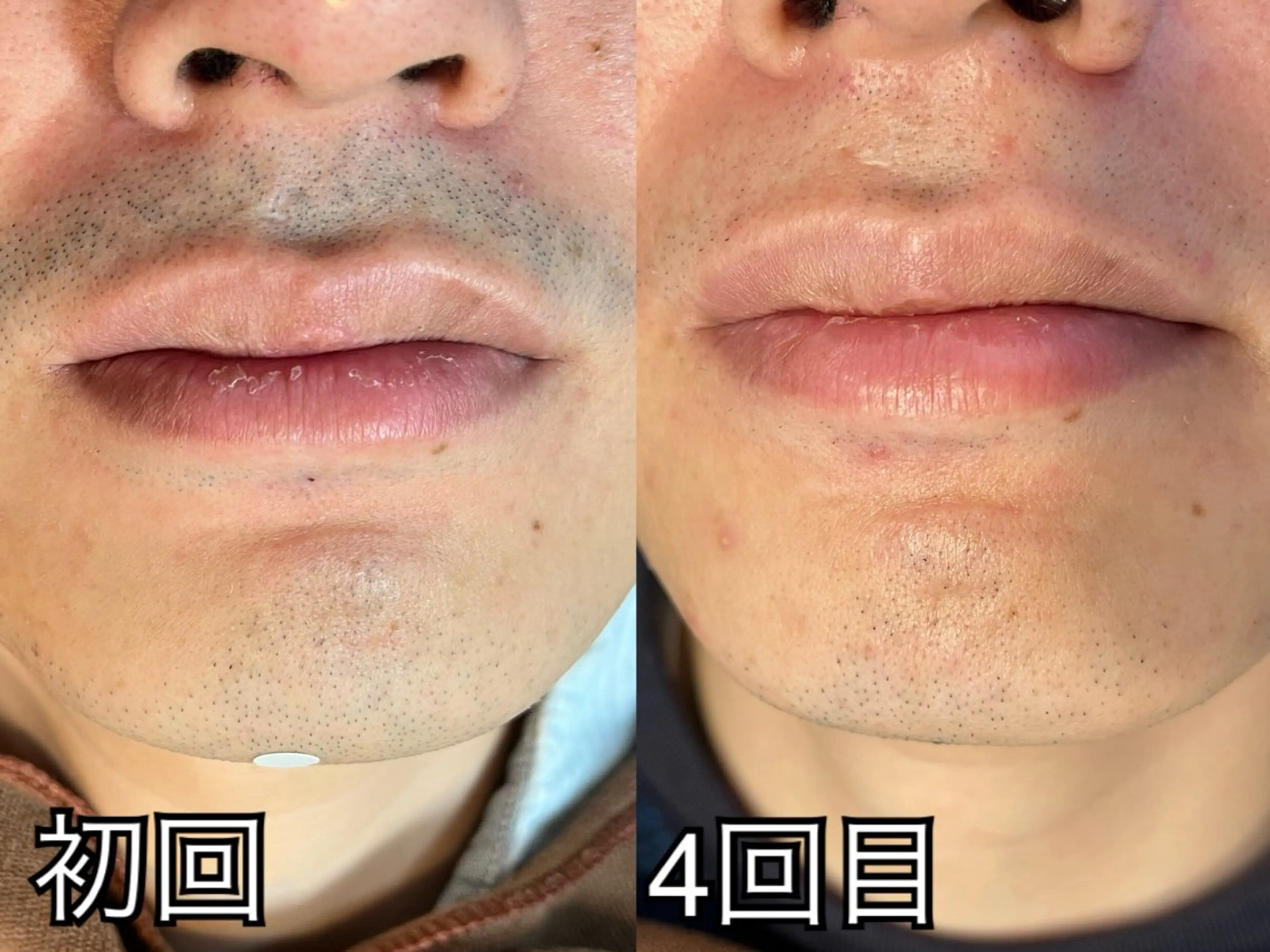 【メンズ専用】髭全体脱毛（期間限定価格）の写真