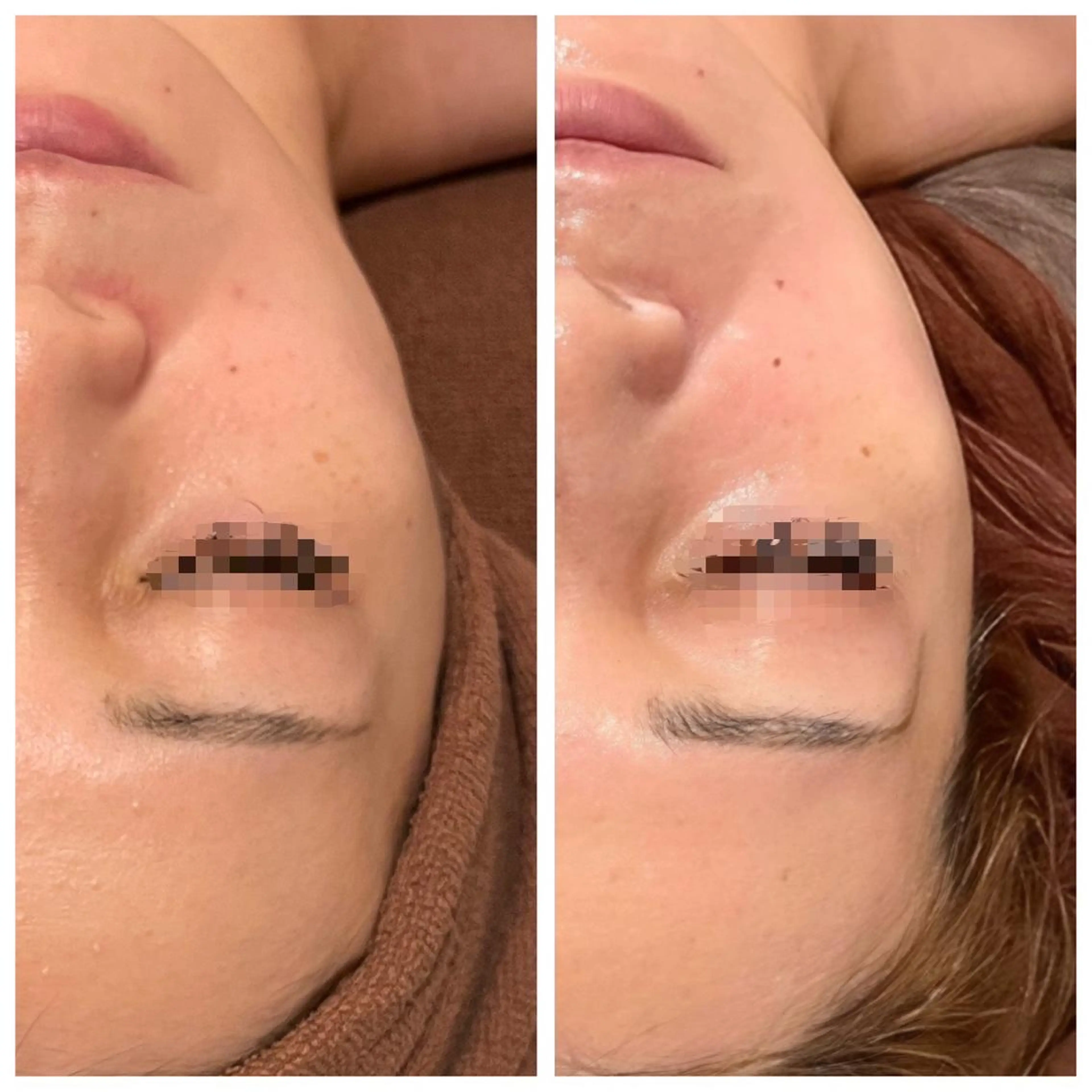 光フェイシャルで脱赤ら顔‪‪😳毛細血管にダイレクトアプローチするから1度で効果を実感❣️その他の施術と同時施術可✨の写真