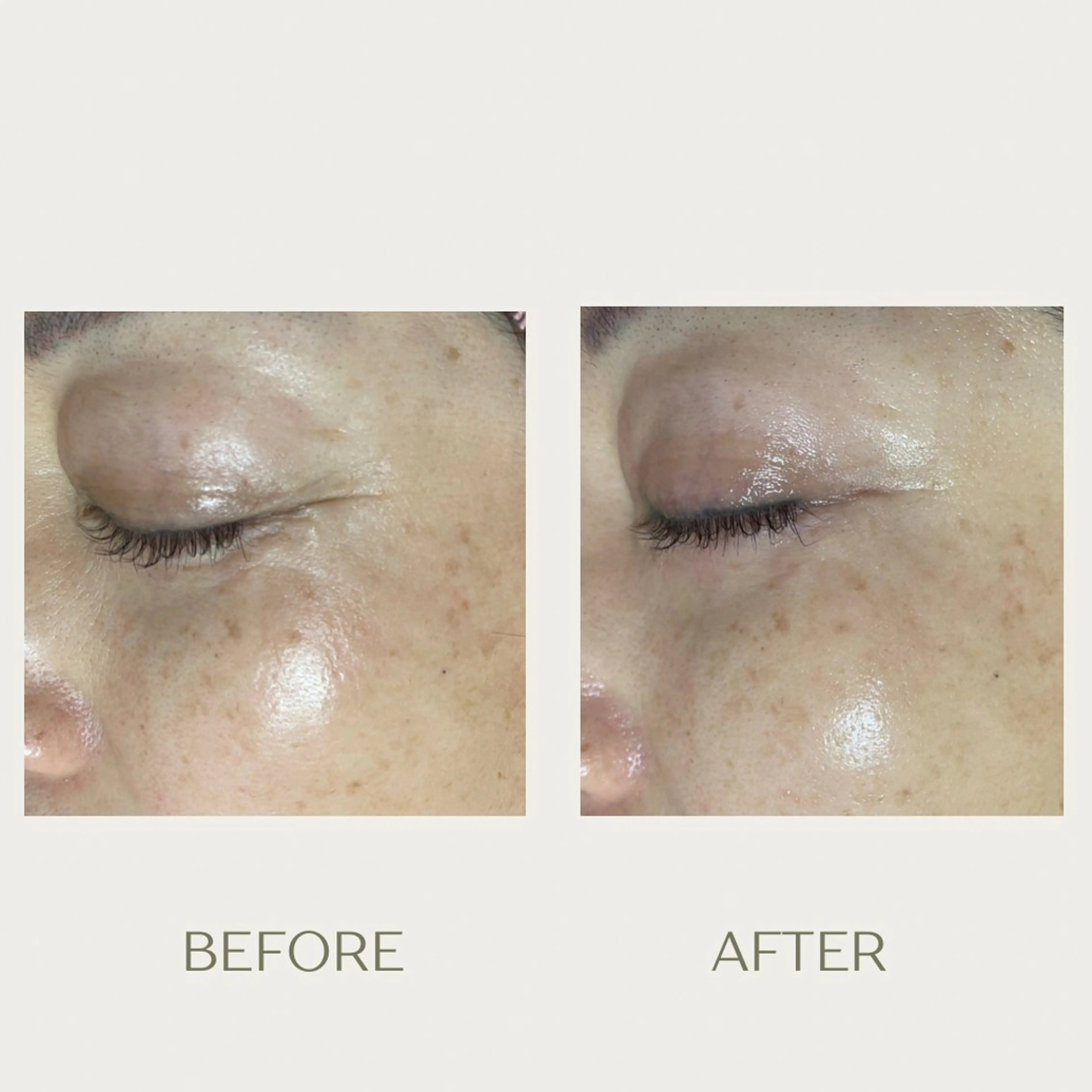 エステ ピーリングケア 🤍moekoのエステ・リラクイメージ