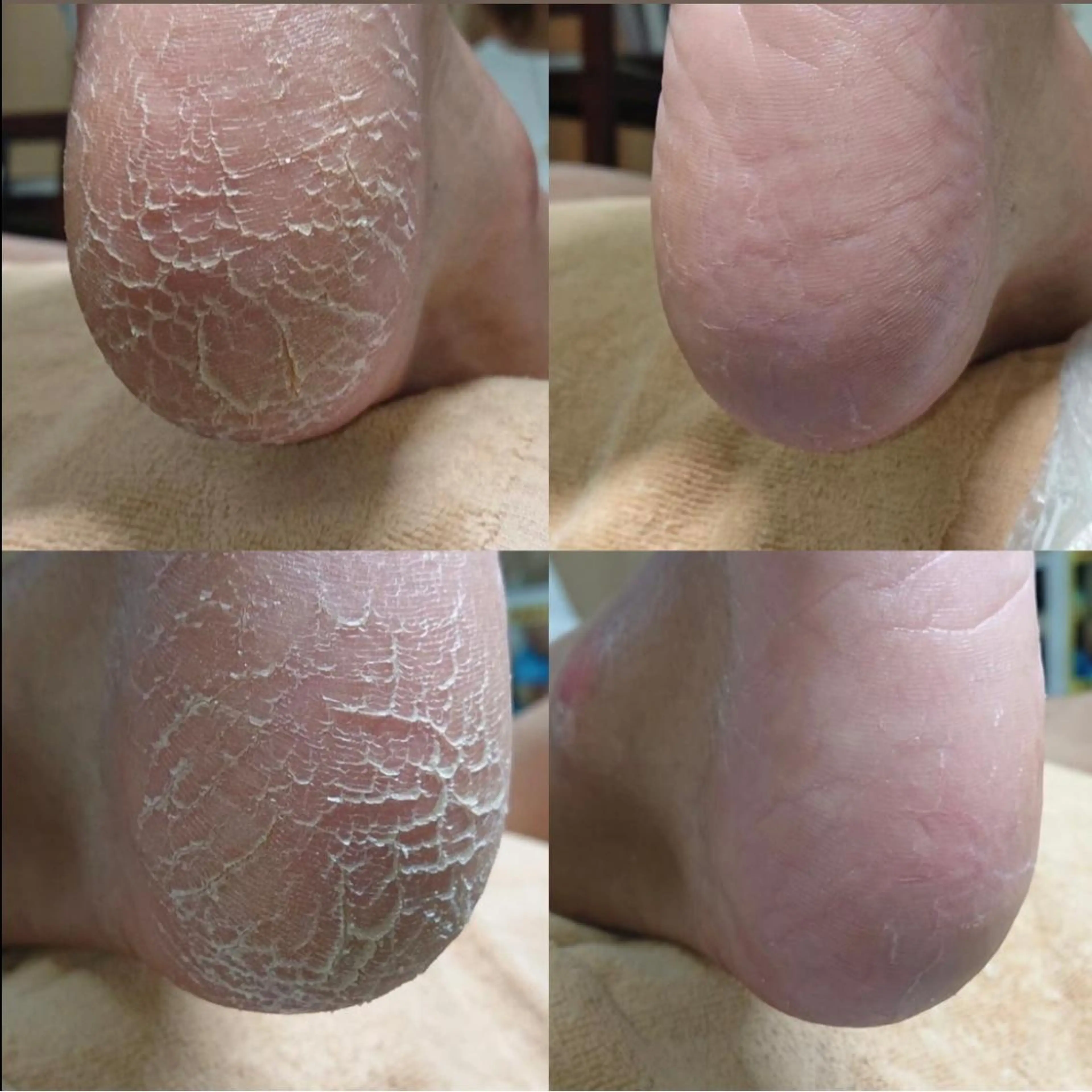 【カカト角質ケア】ガサガサ角質もツルスベに✨✨仕上がり大満足💁‍♀️◎の写真