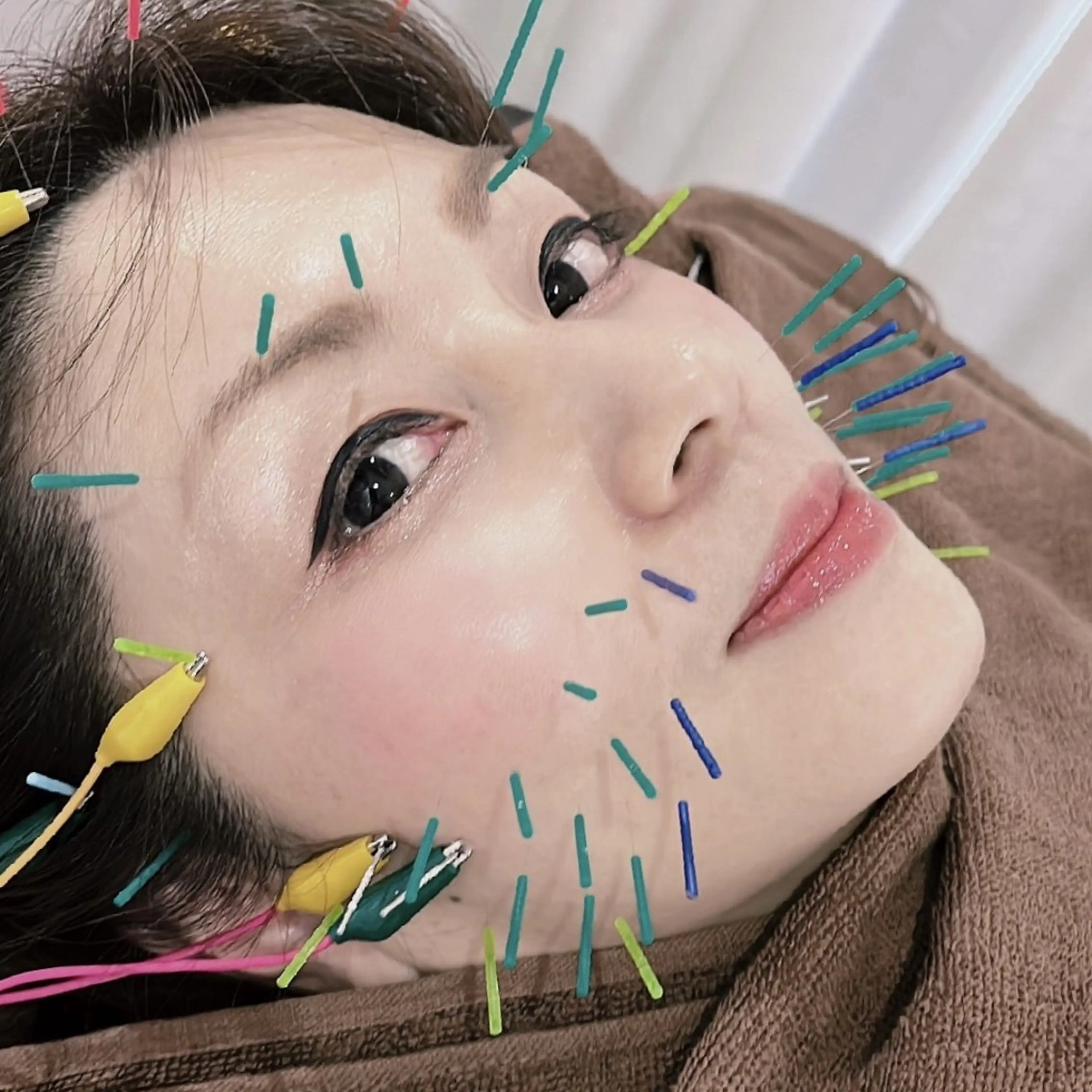 ⚠️ミニモ限定[⚙️お顔のケア/メンテナンスに]🌈美容鍼＋パルス　60分の写真