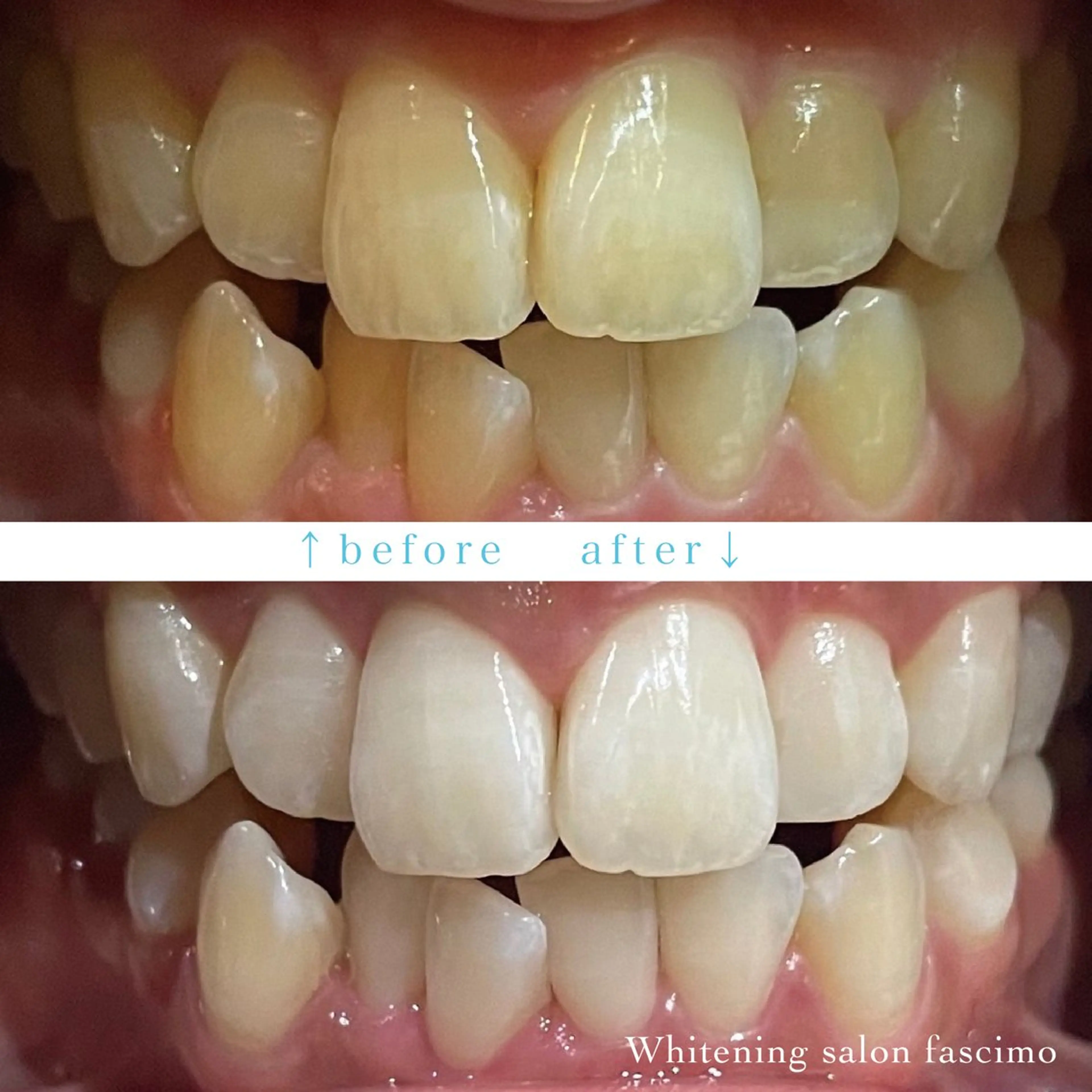 ㊗️１周年記念キャンペーン🎉8分×2回照射💡セルフホワイトニング6,600円→2,200円🫧２倍効果パープルライトの写真