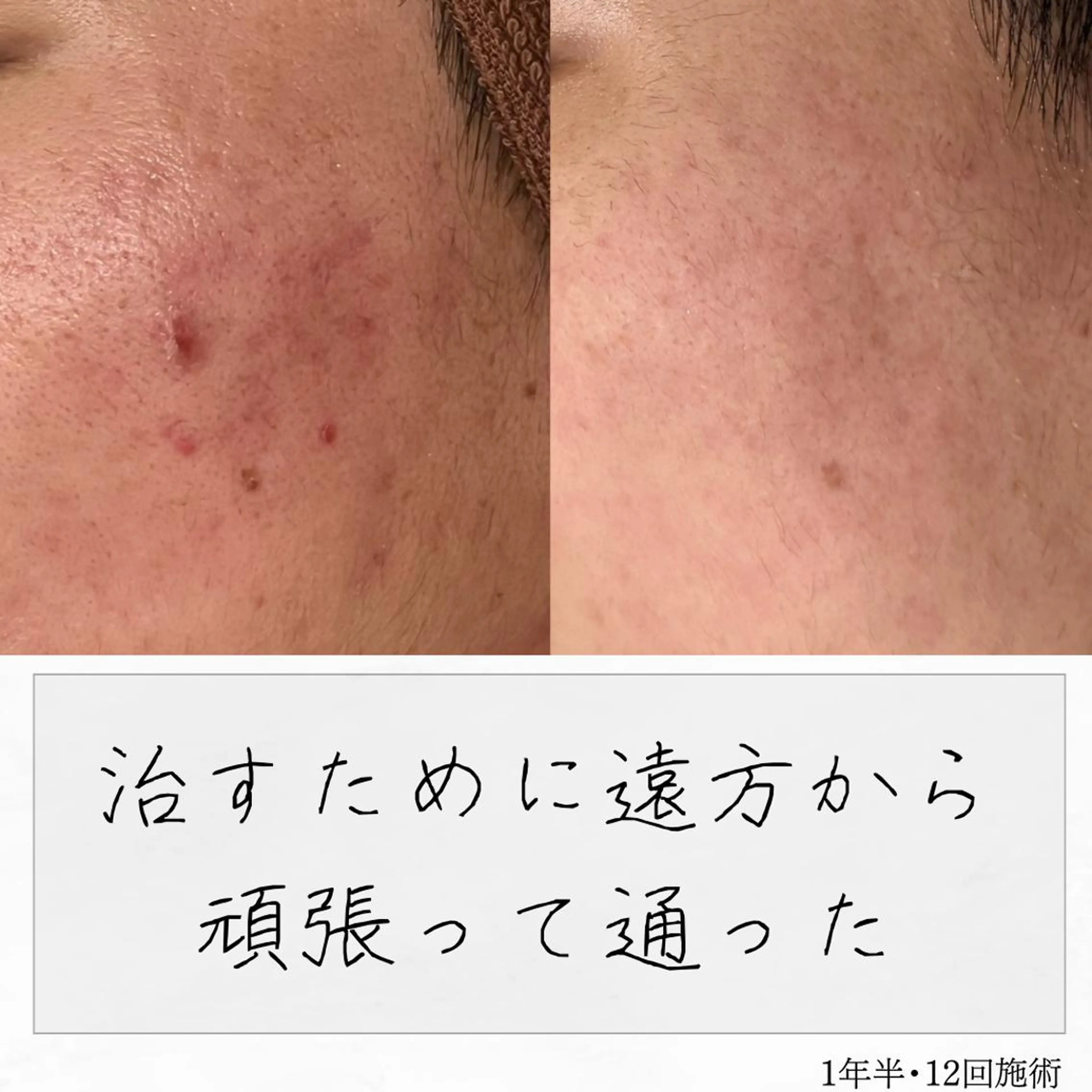 ニキビ経験者が施術 する専門サロン🌻のエステ・リラクイメージ