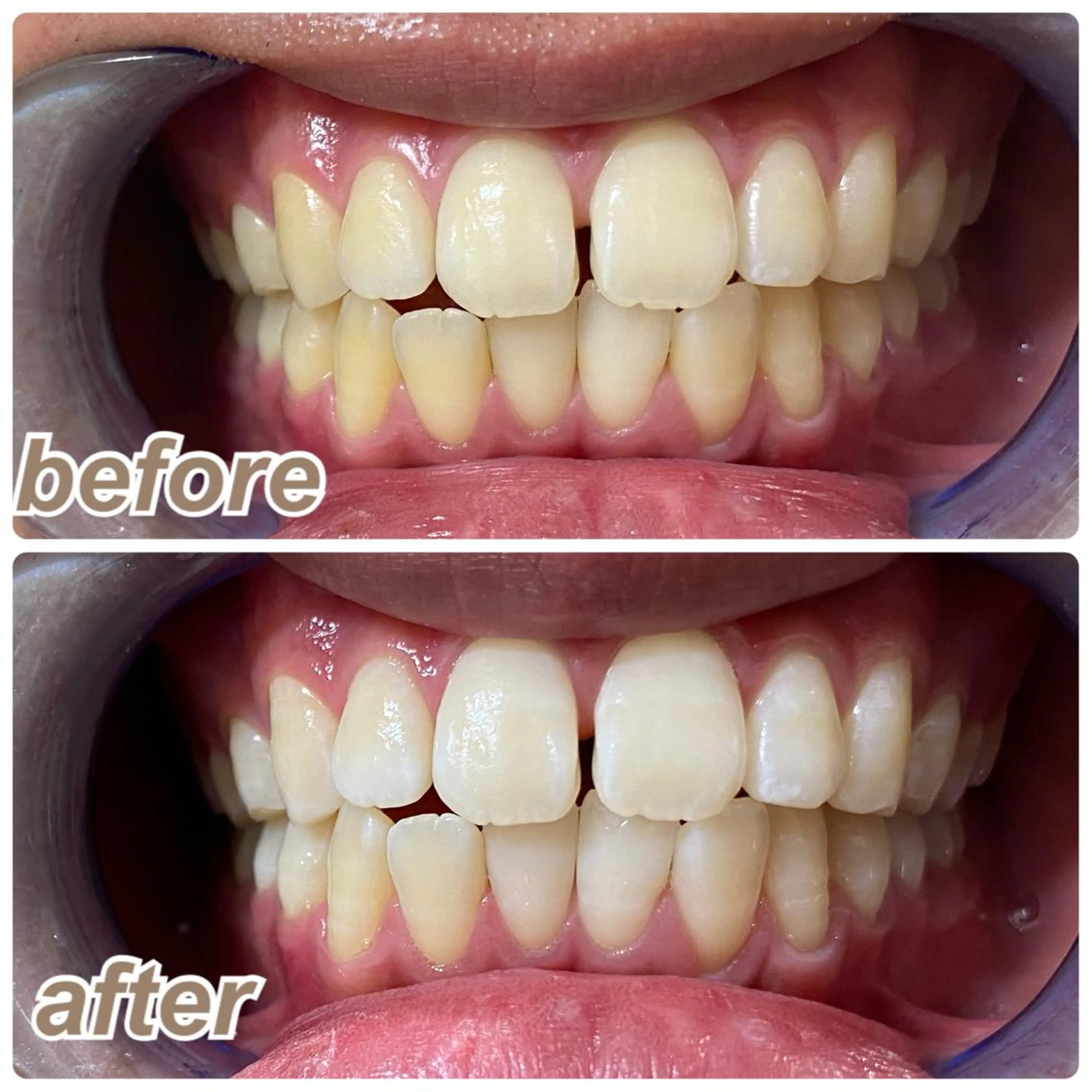 その他 セルフホワイトニング 🦷口元垢抜け✨のその他イメージ