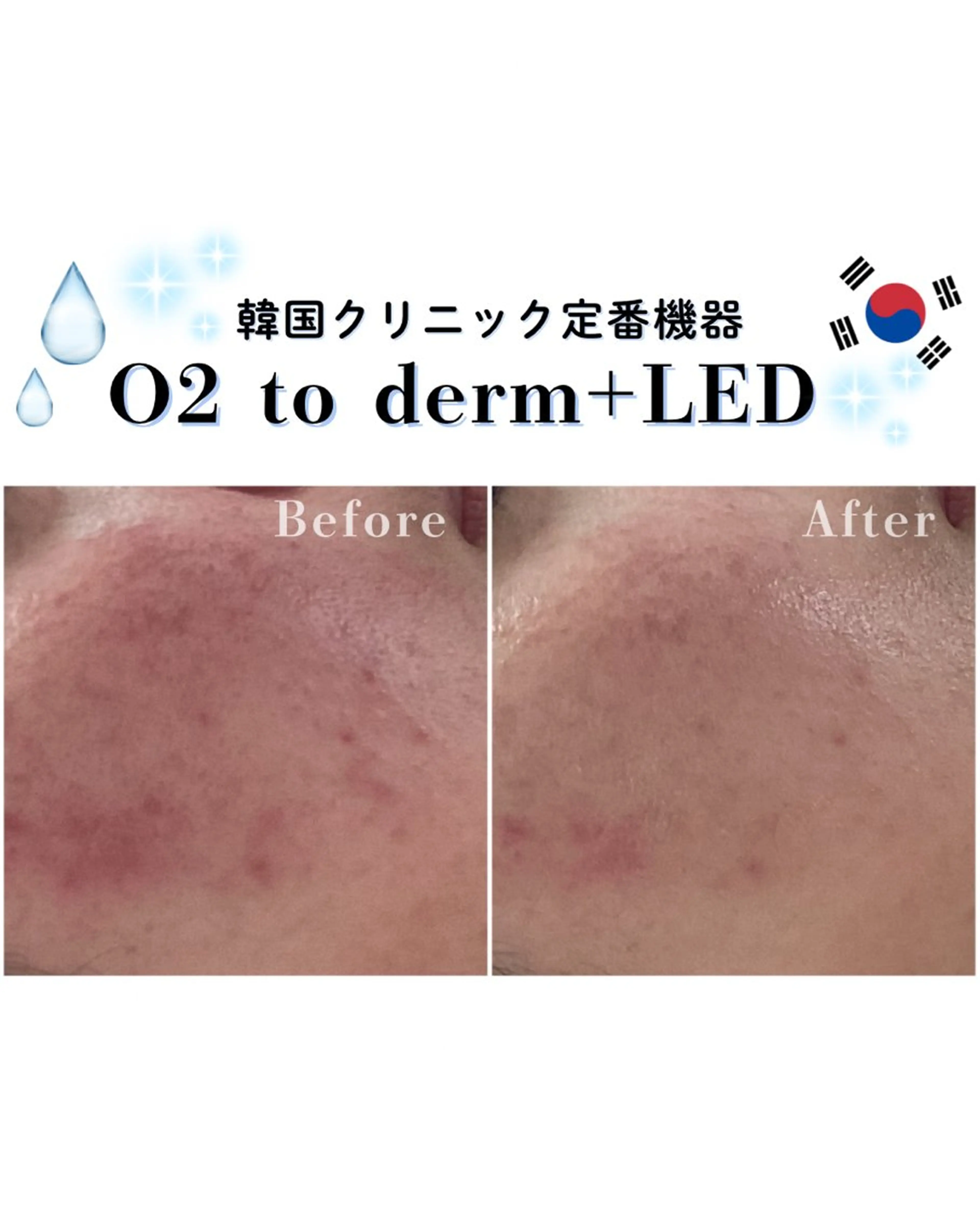 韓国肌管理🇰🇷 水光肌/肌質改善🫧のエステ・リラクイメージ