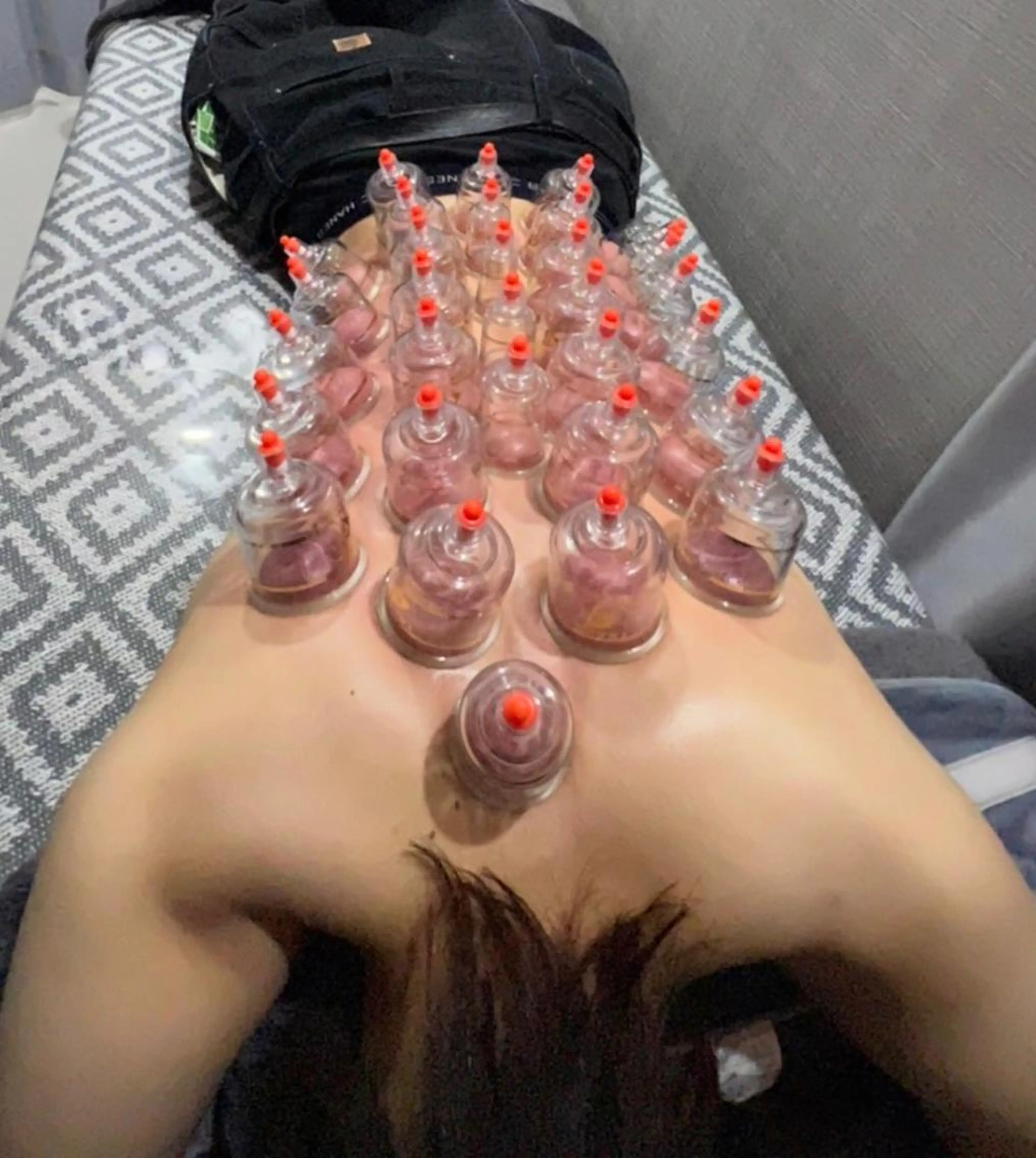 【男性スタッフ対応】背面カッピング(60分)の写真