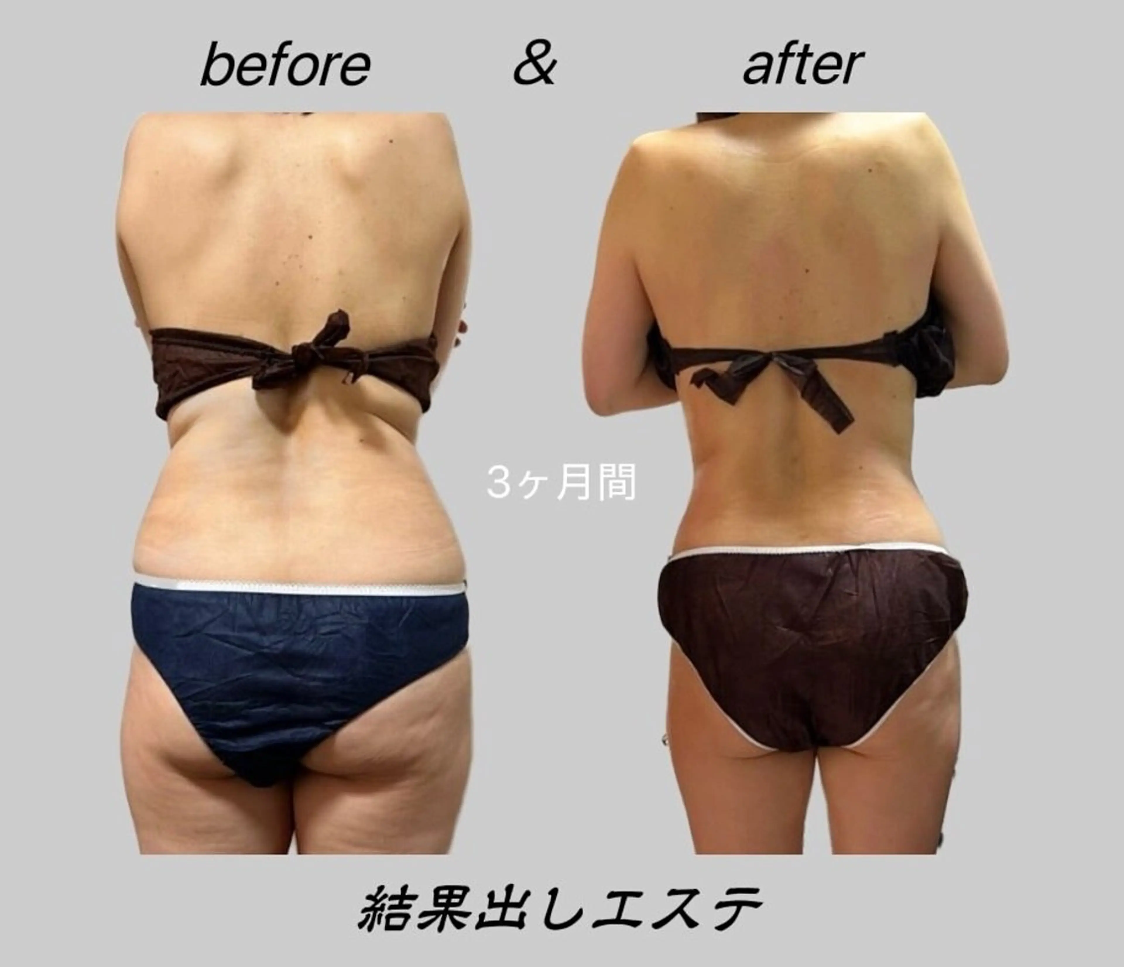 【後ろ姿まで美しく】背面集中痩身ボディデザイン60分21,000円→の写真