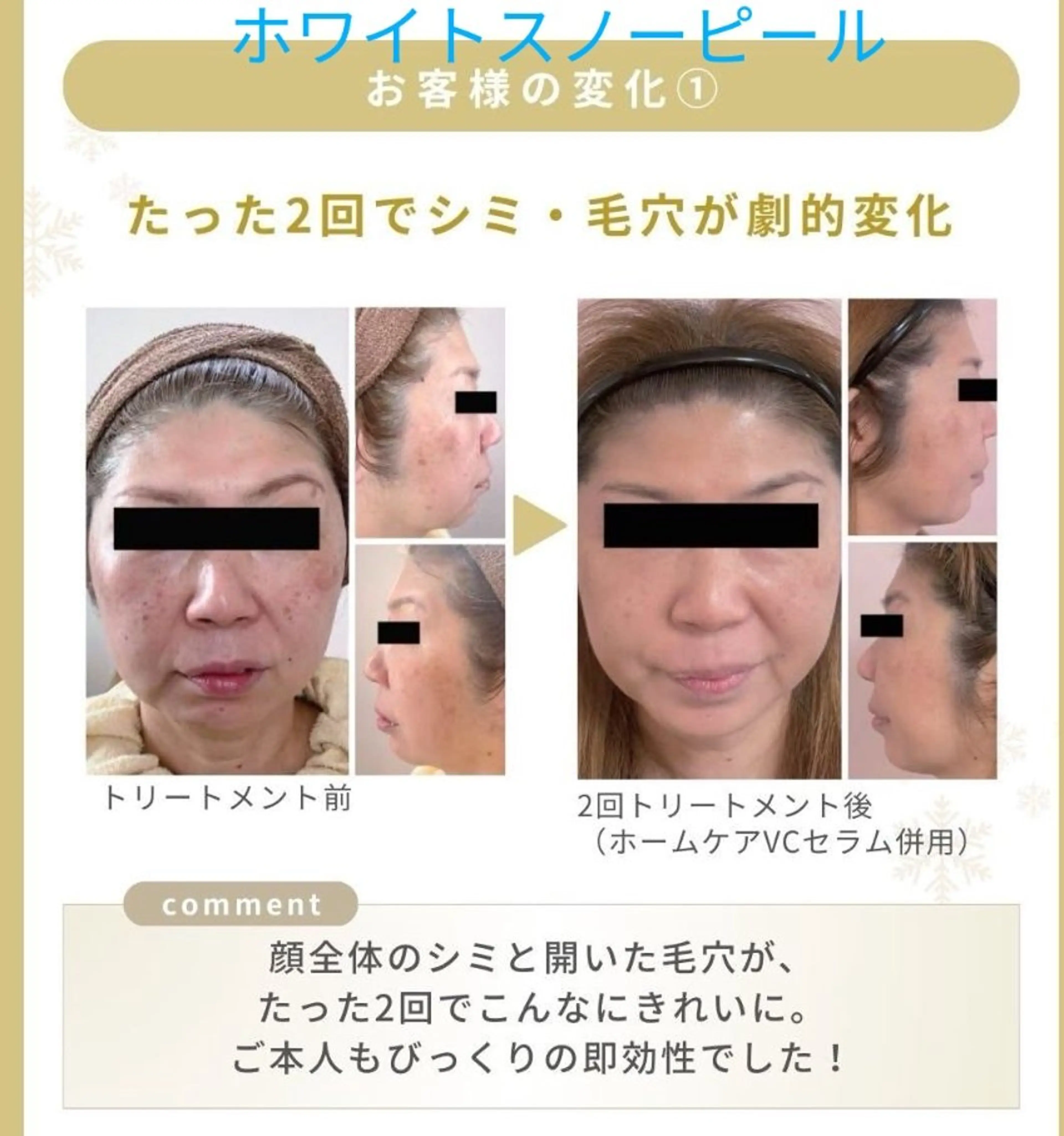 エリア初導入【透明感・ツヤ特化】ホワイトスノーピール・水光コースの写真