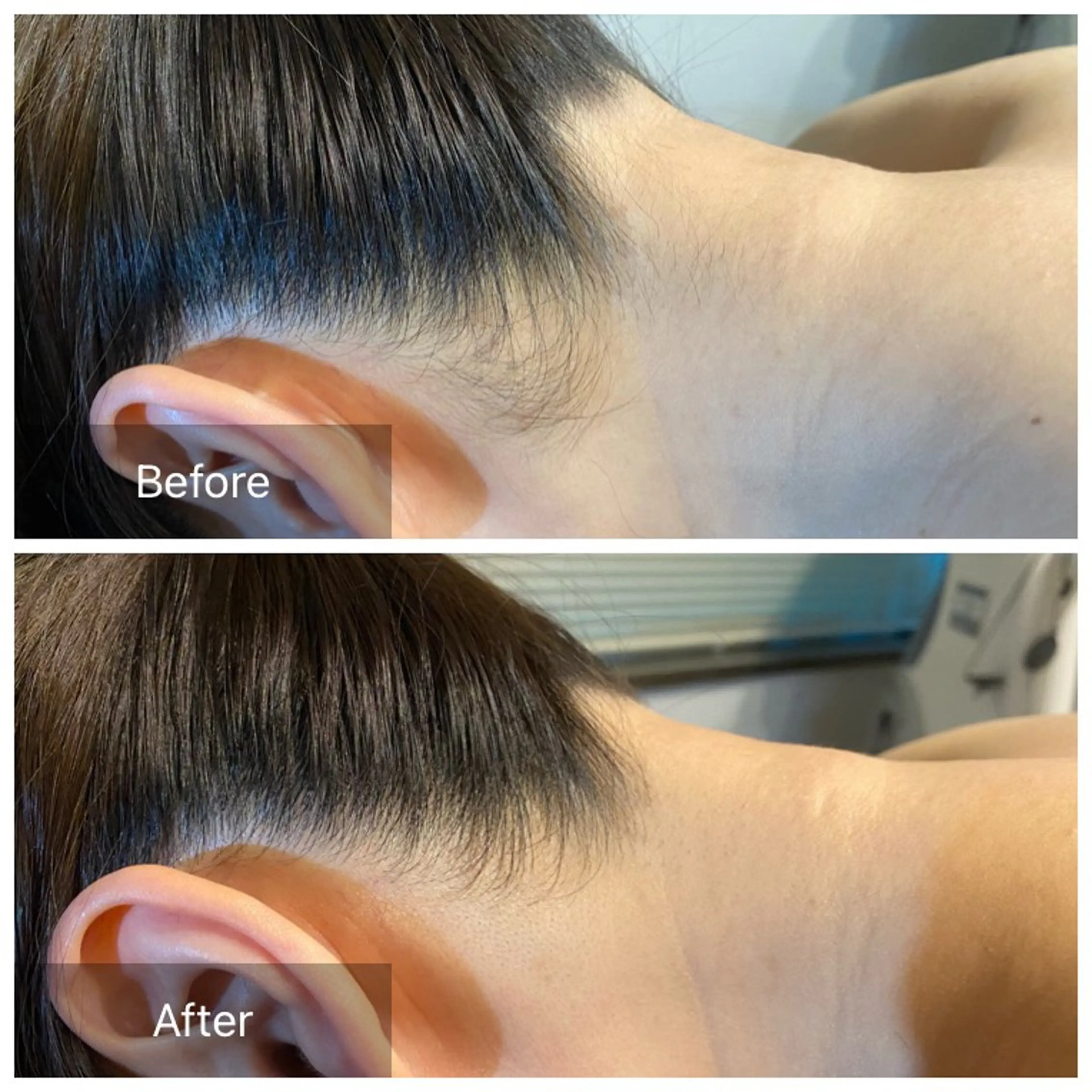 初回女性背中＆うなじ脱毛　¥3800 【口コミ必須】の写真