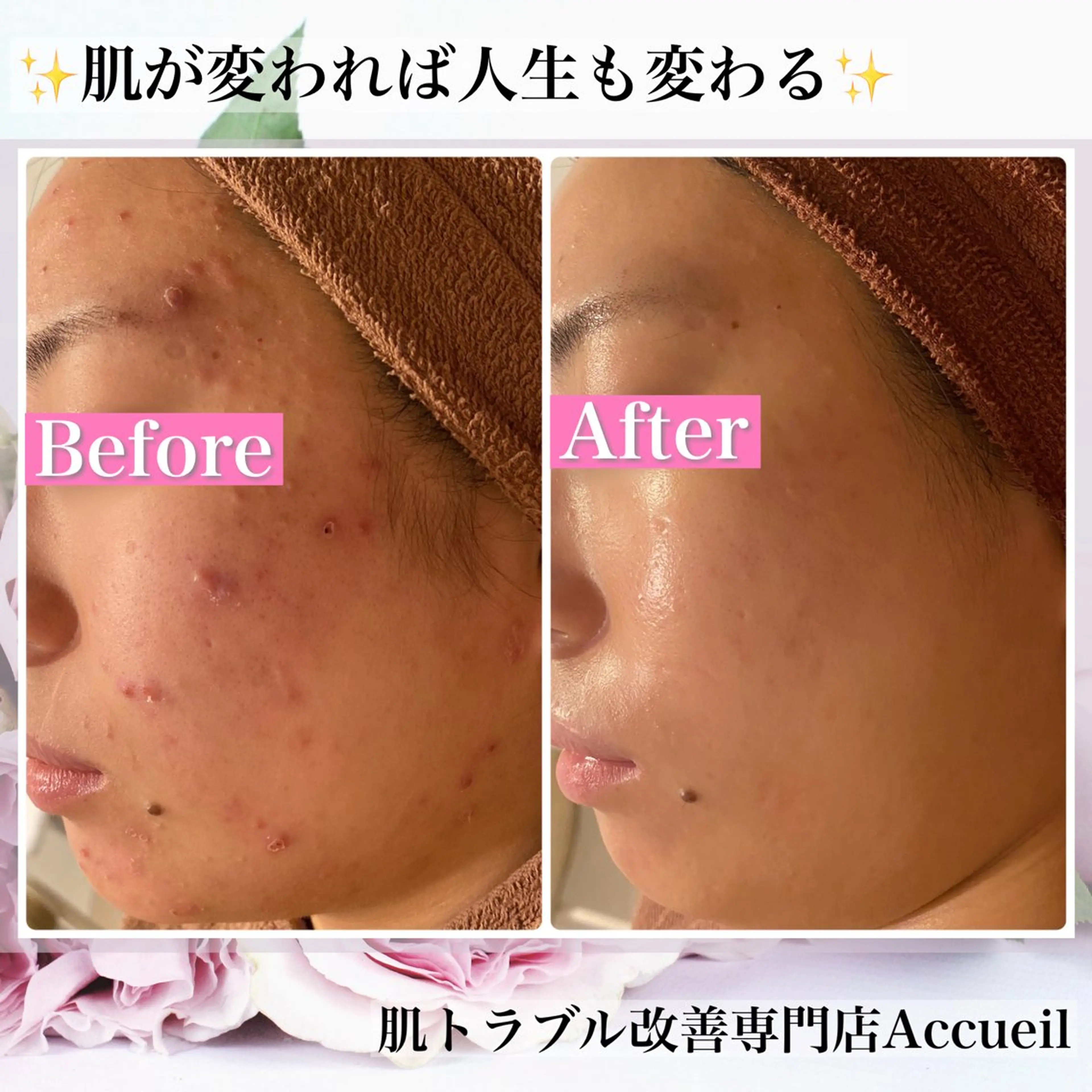 エステ リラク ニキビ・肌質改善専門 ♡人生が変わるサロンのエステ・リラクイメージ