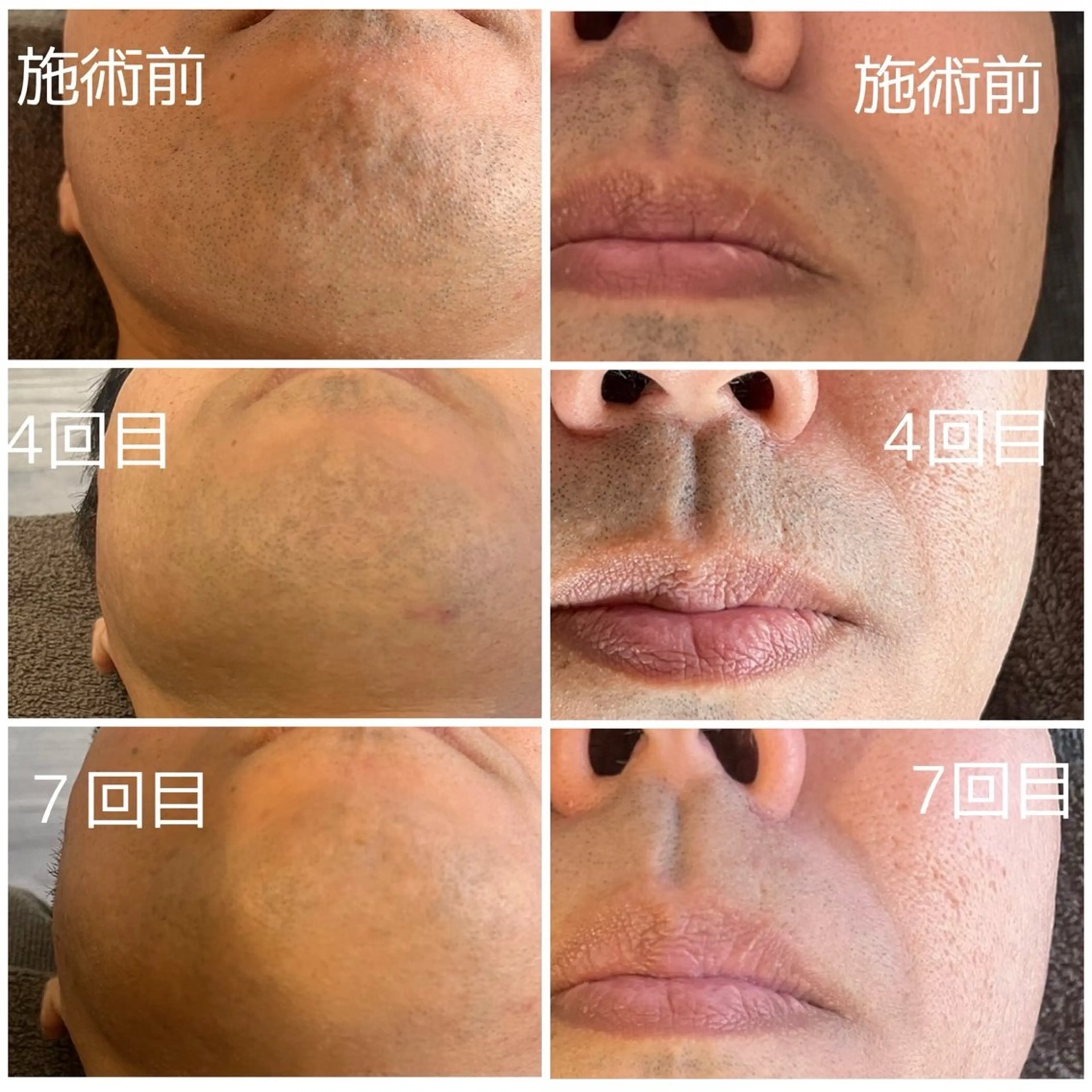 脱毛 MEGURU所属・篠原 由紀野のエステ・リラクイメージ