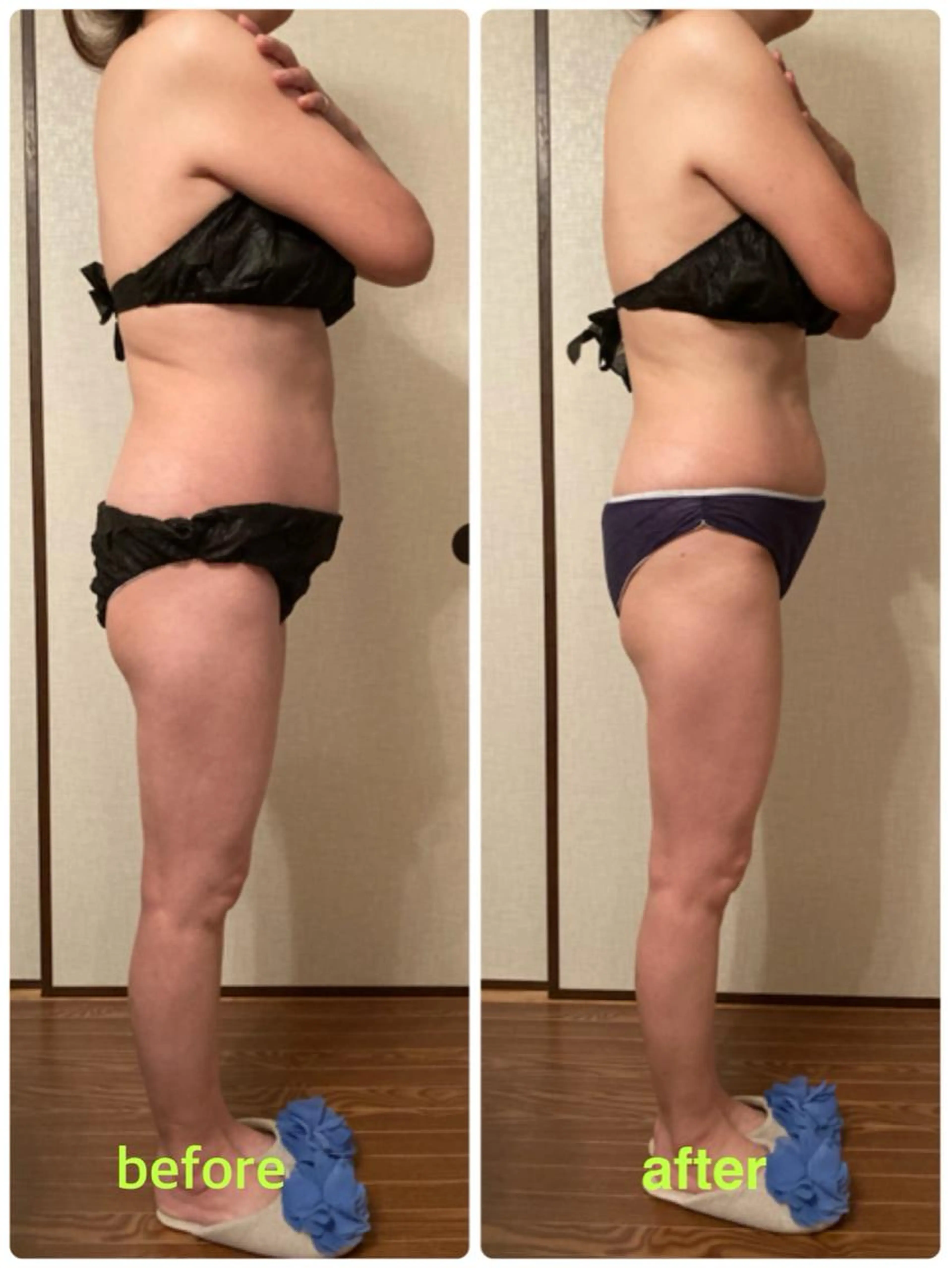 【ラジオ波痩身エステ】下半身(太もも・ふくらはぎ・ヒップ・お腹) 排出リンパ＆セルライト潰し100分の写真