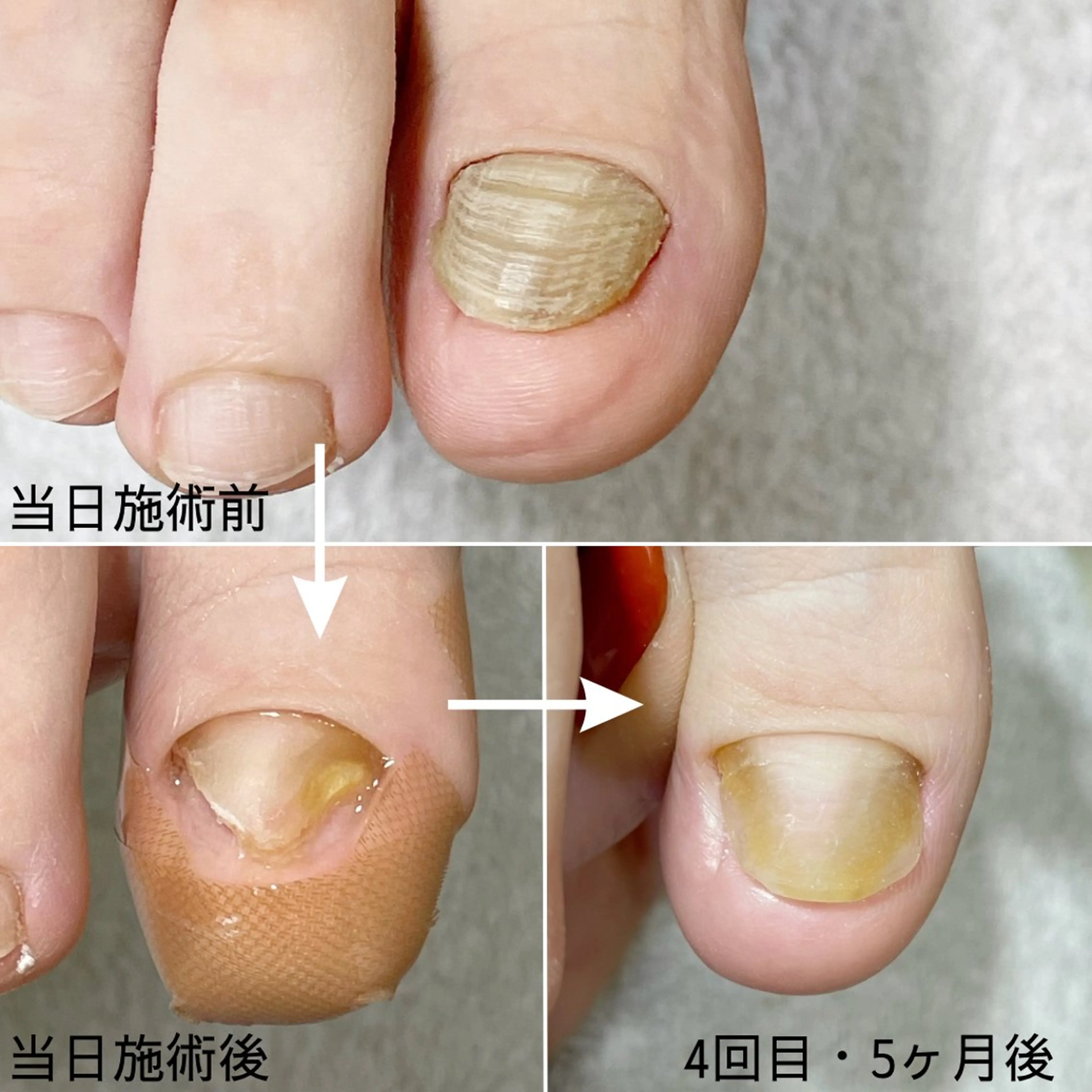 ネイル 深爪・巻き爪 専門サンセリテのネイルデザイン