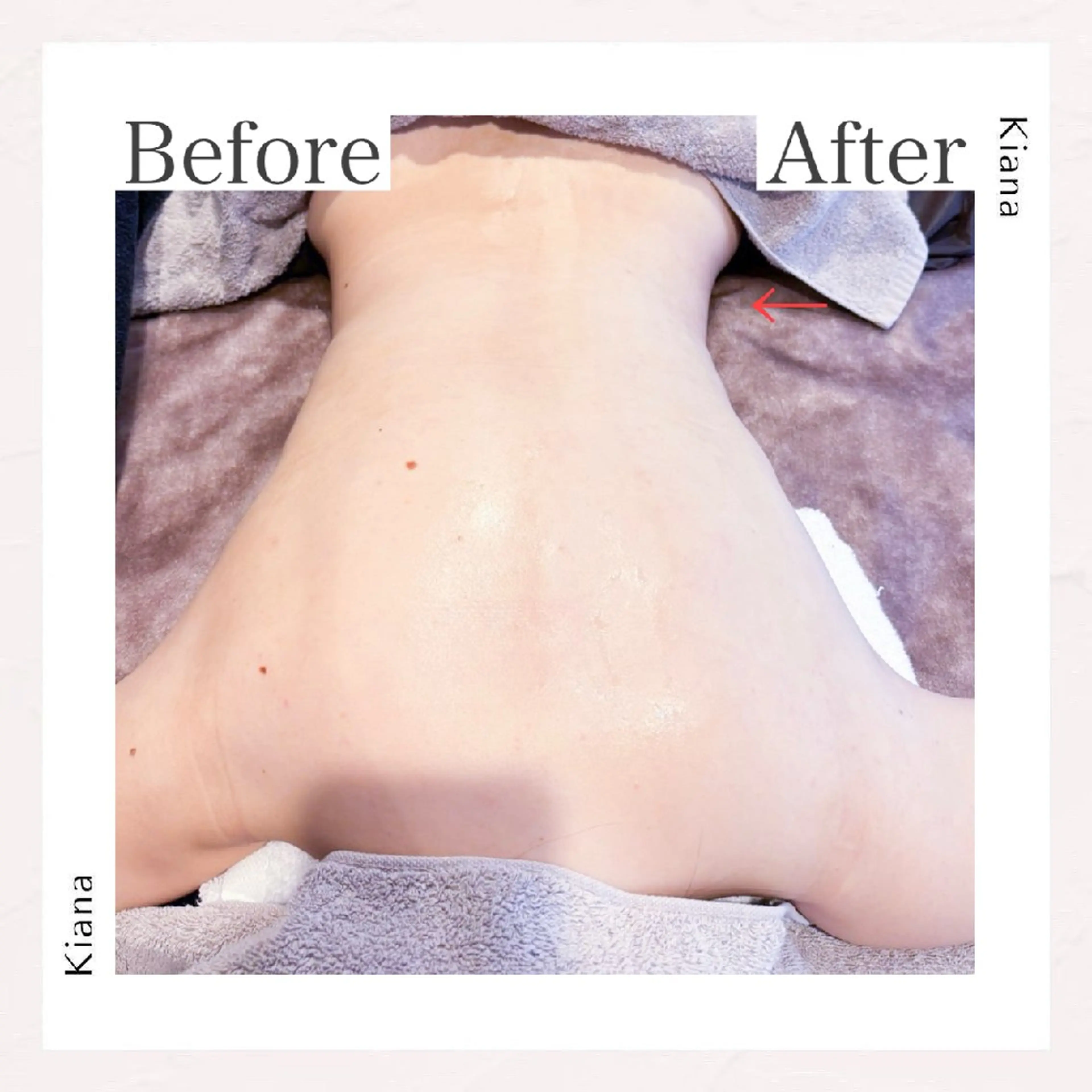 💎全身スリムコース💎　RF &クラッシュ吸&ハンド　施術80分の写真