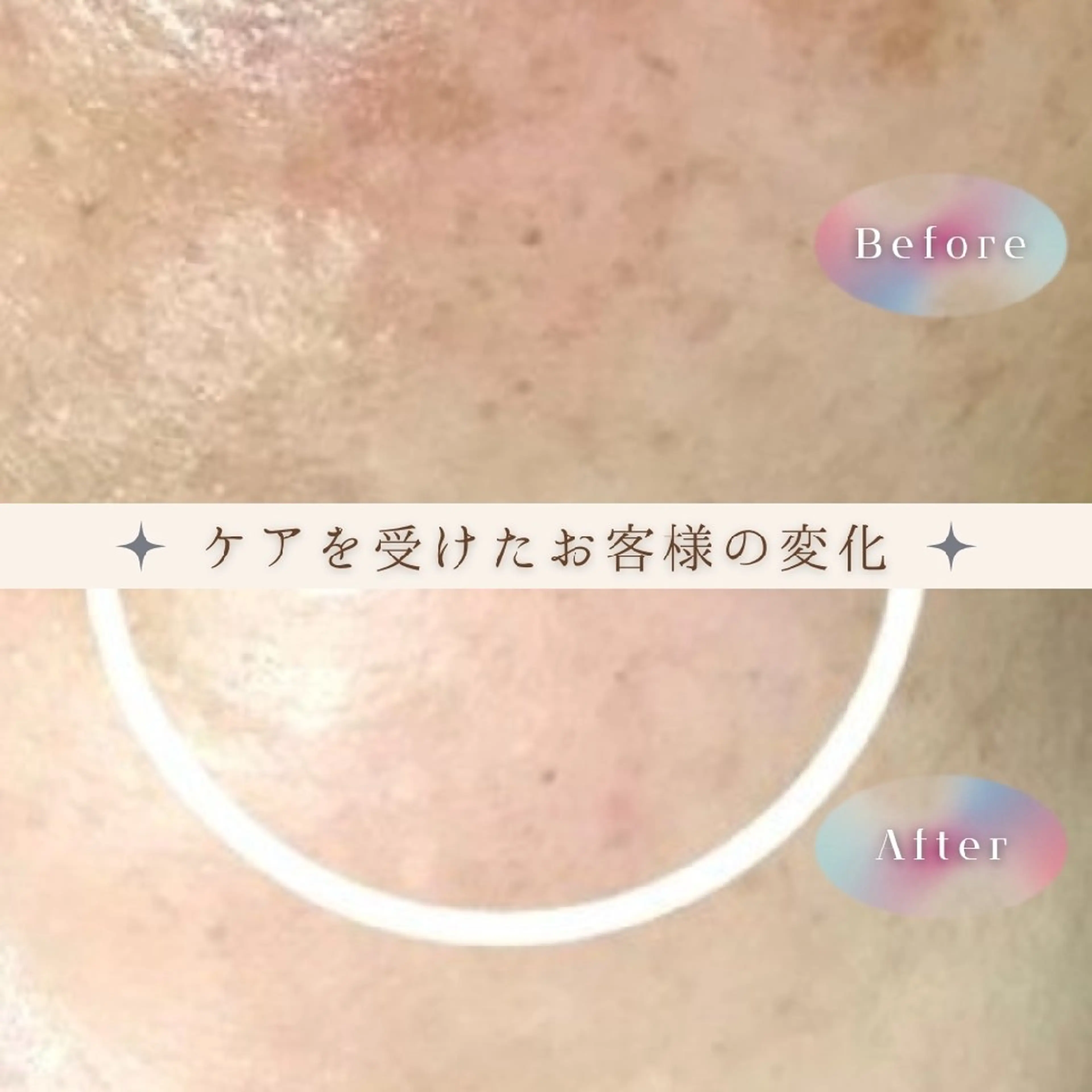 エステ 肌質改善BIOELプ ラズマ/ラミピールのエステ・リラクイメージ