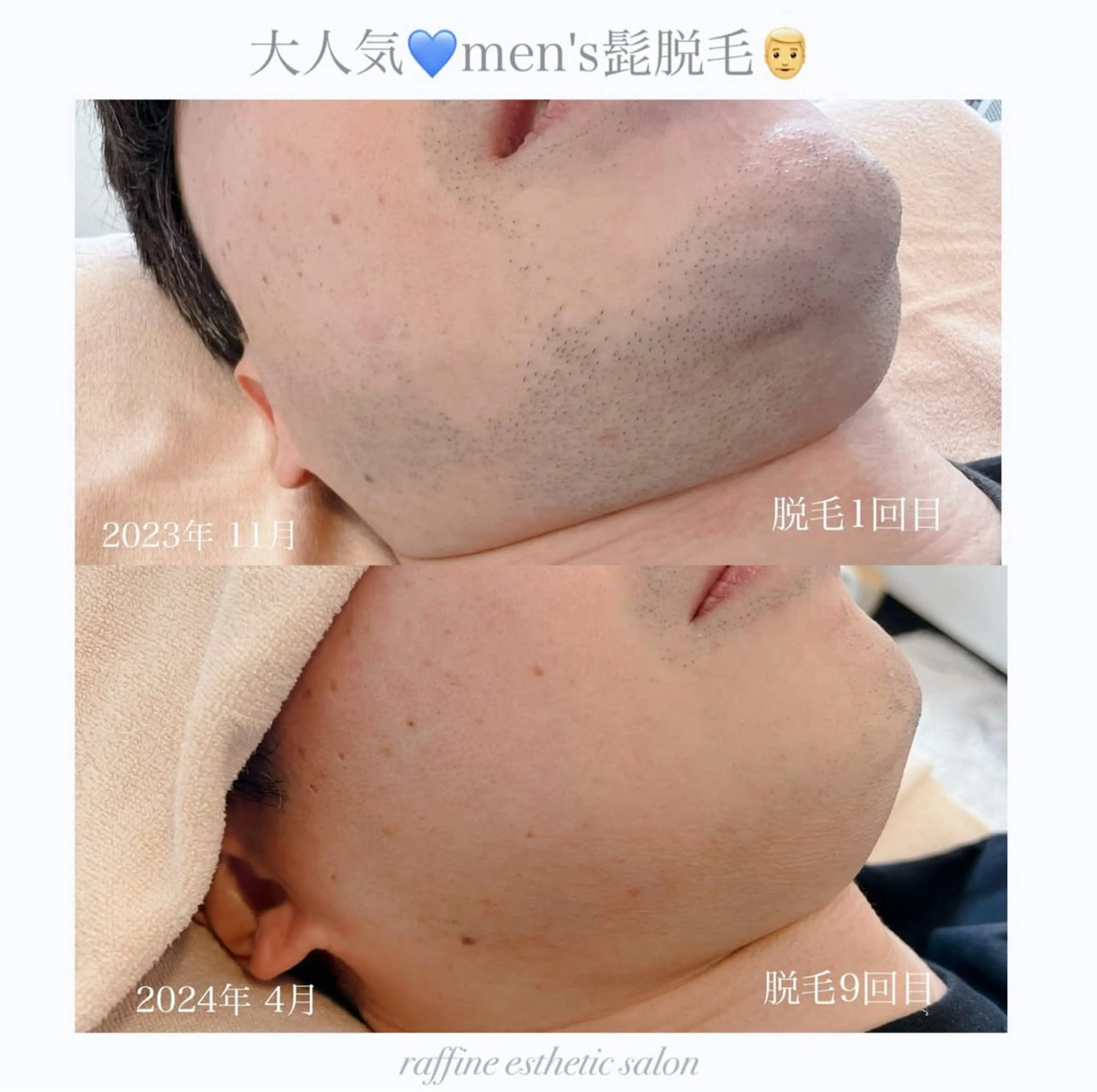 raffine  esthetic salon所属・🌻raffine 脱毛/まつ毛/ヘアーのエステ・リラクイメージ