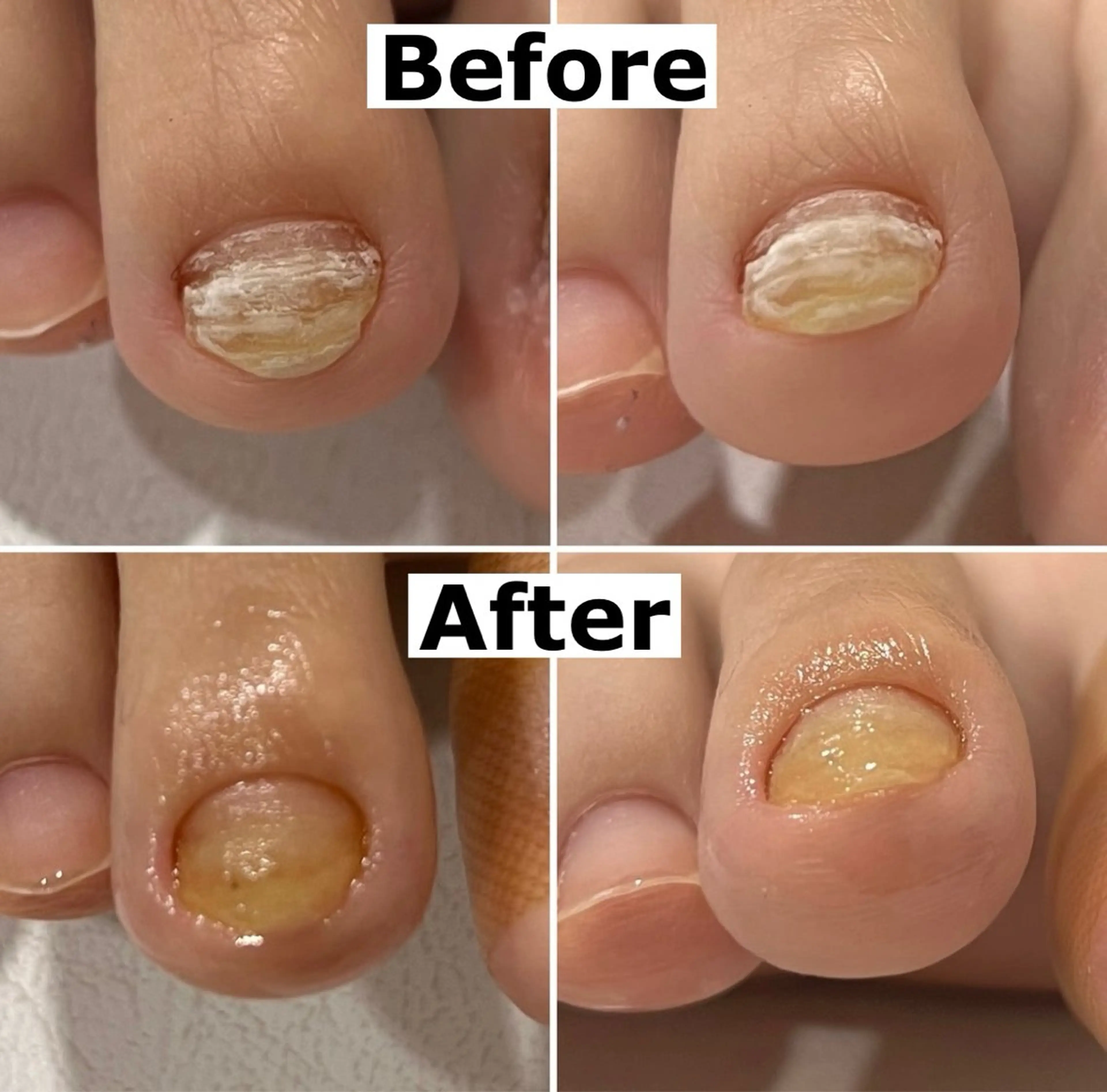 ネイル Mellow nail所属・巻爪無料モデル募集 ✨🦶MEGUMIのネイルデザイン