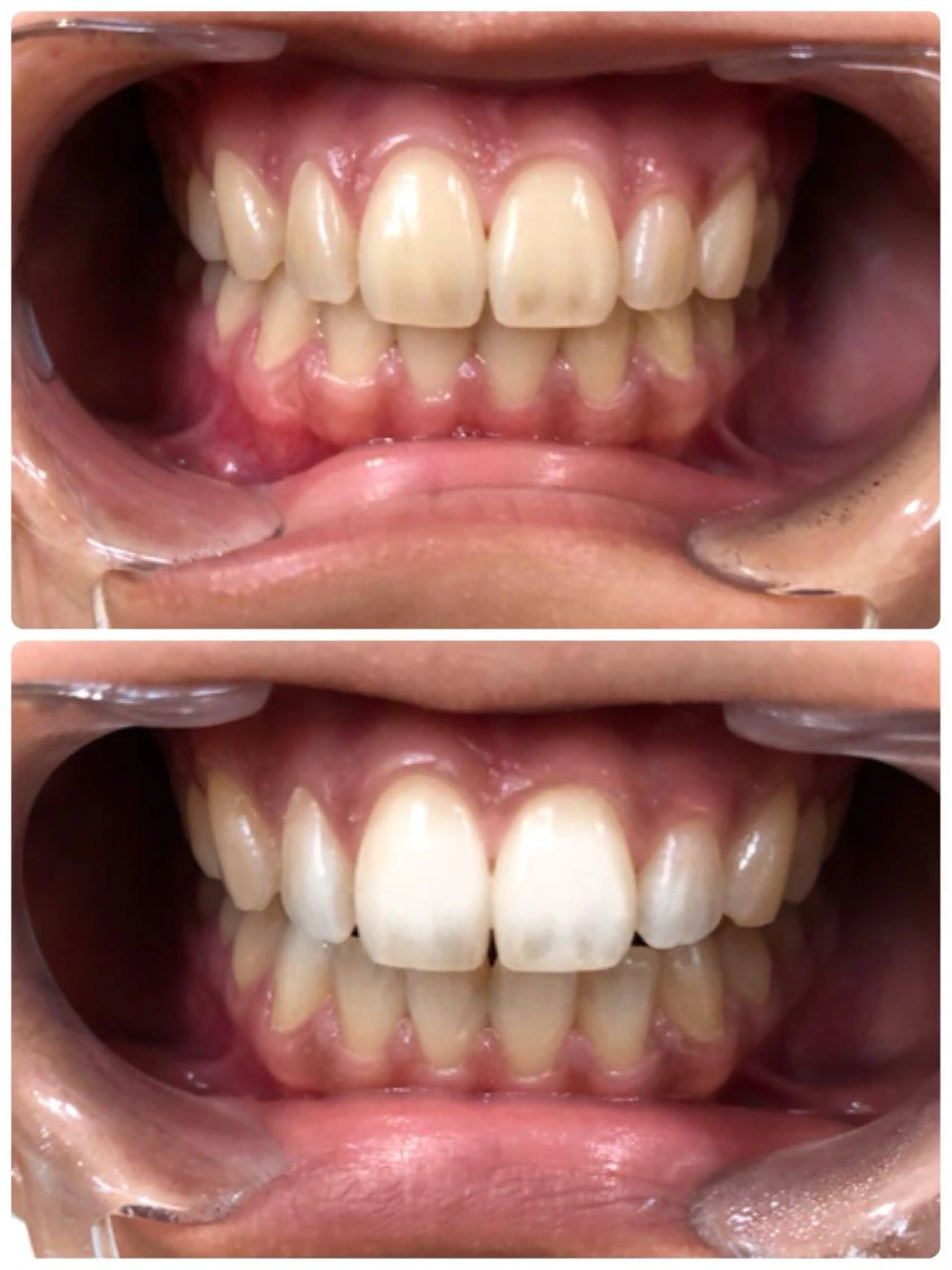 新規キャンペーン🌸セルフホワイトニング🦷　8分×2回照射（すべてお客様ご自身でして頂く歯のホワイトニングです！）の写真