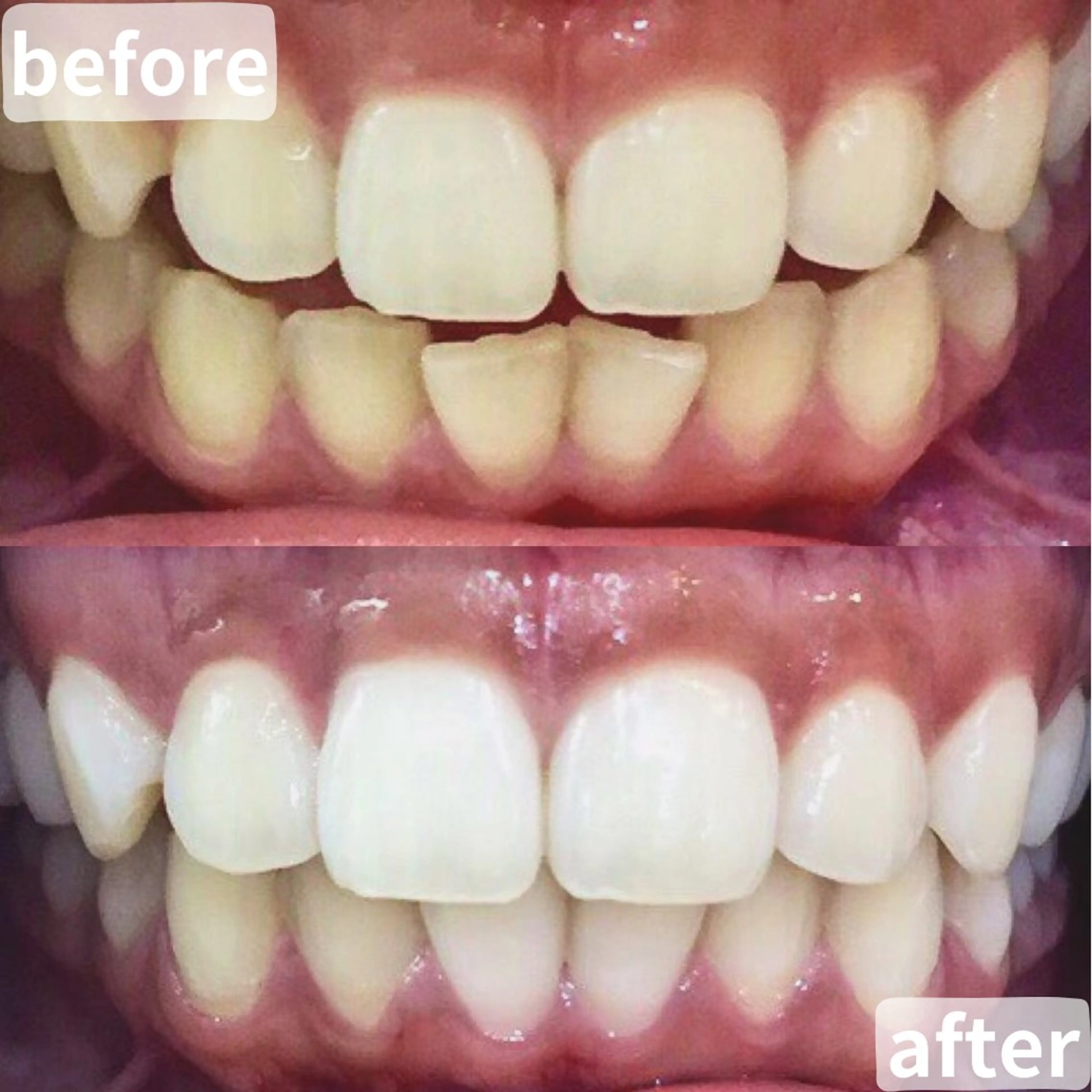 ❤️手軽に歯を白くしたい方へ❤️通常の2倍の照射パワー💪最新高速ハイパワーセルフホワイトニング5分×2回🦷✨の写真