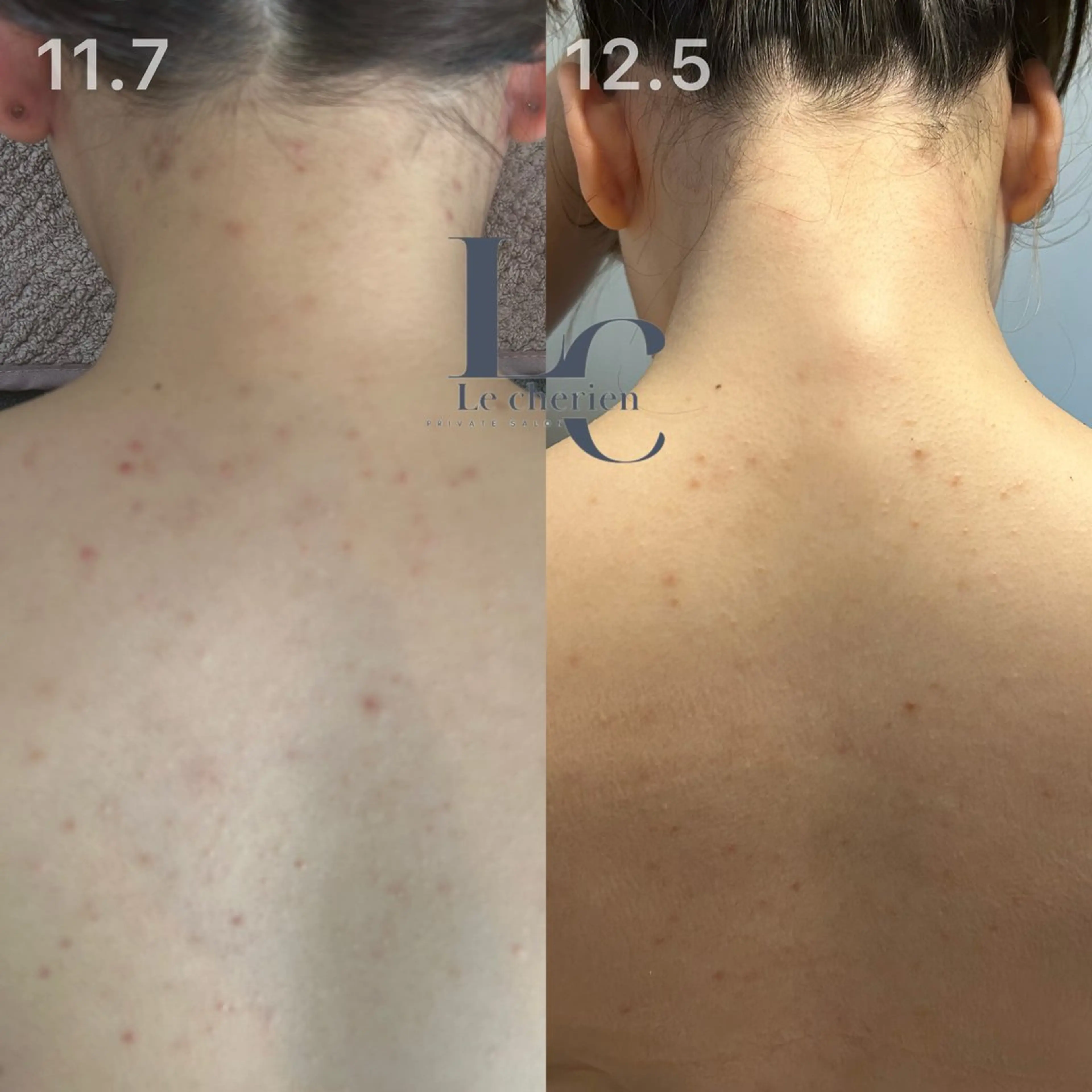 陶肌トリートメント　ハーブピーリング🌿お背中上半分の写真