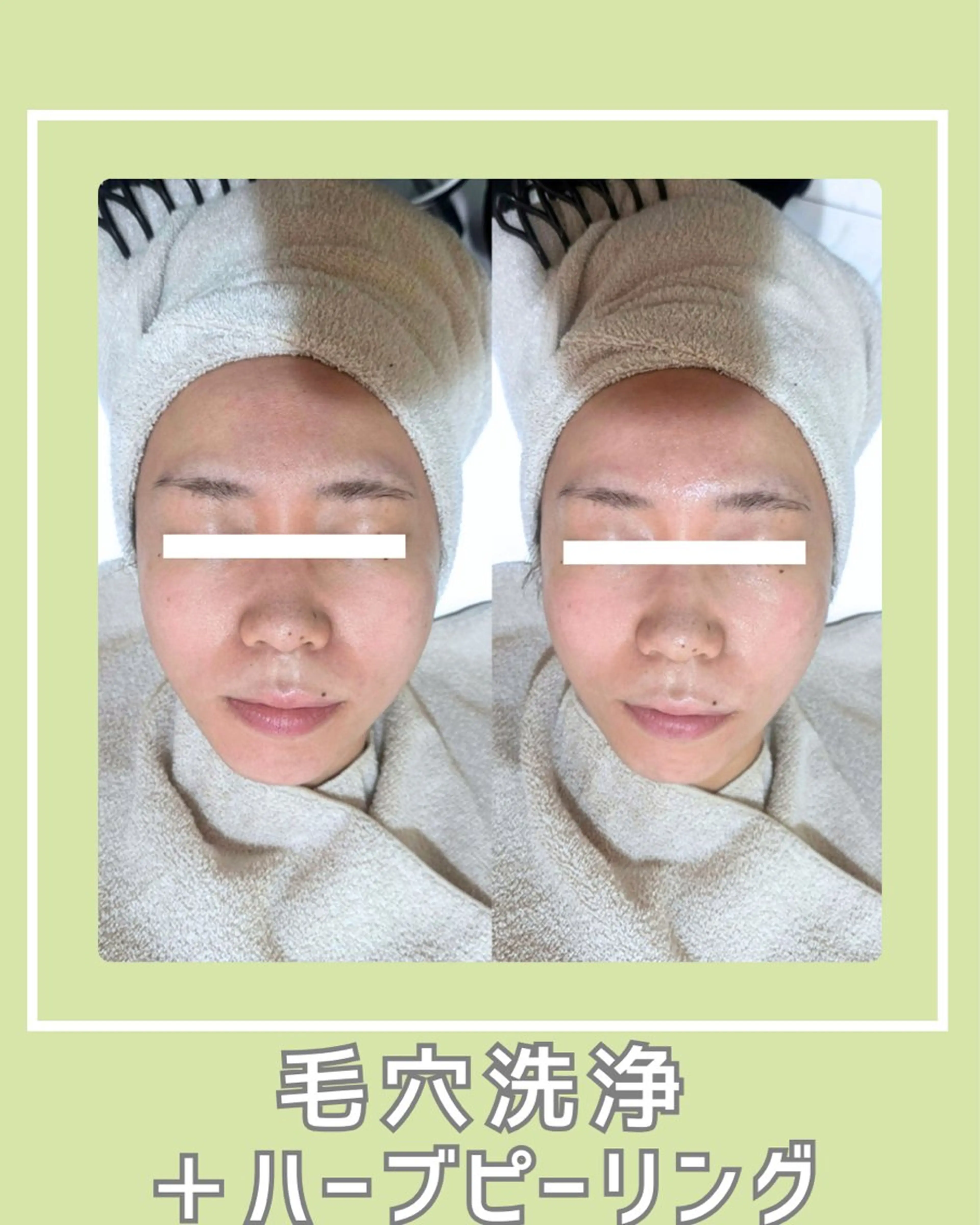 |ピーリング・毛穴| soina神楽坂のエステ・リラクイメージ