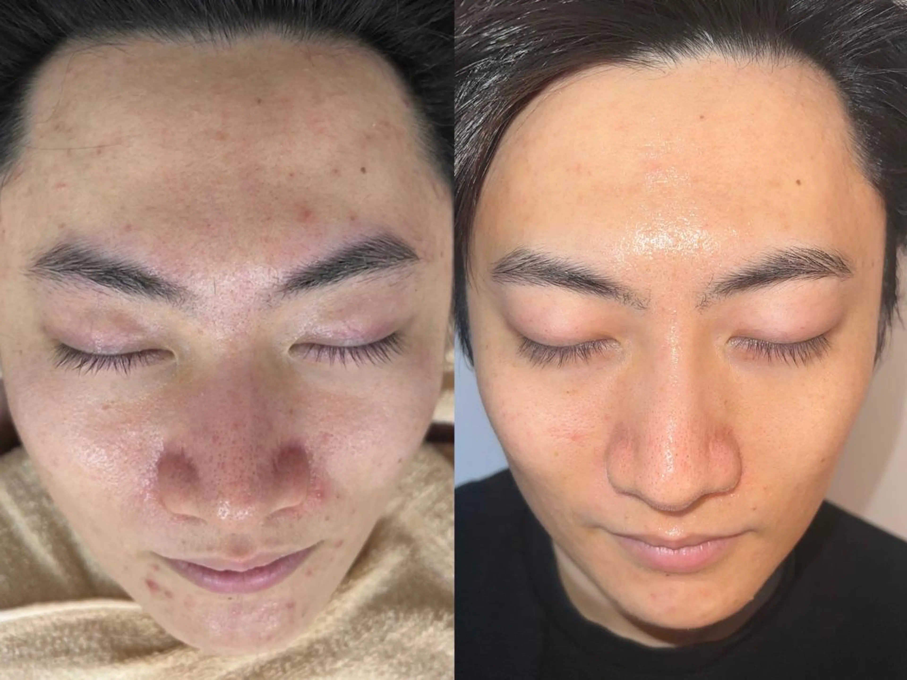 メンズ ハーブピーリング /毛穴ケア/脱毛/韓国ツヤ肌専門店【HARU.】所属・全身脱毛/韓国ツヤ肌 ハーブピーリングのエステ・リラクイメージ