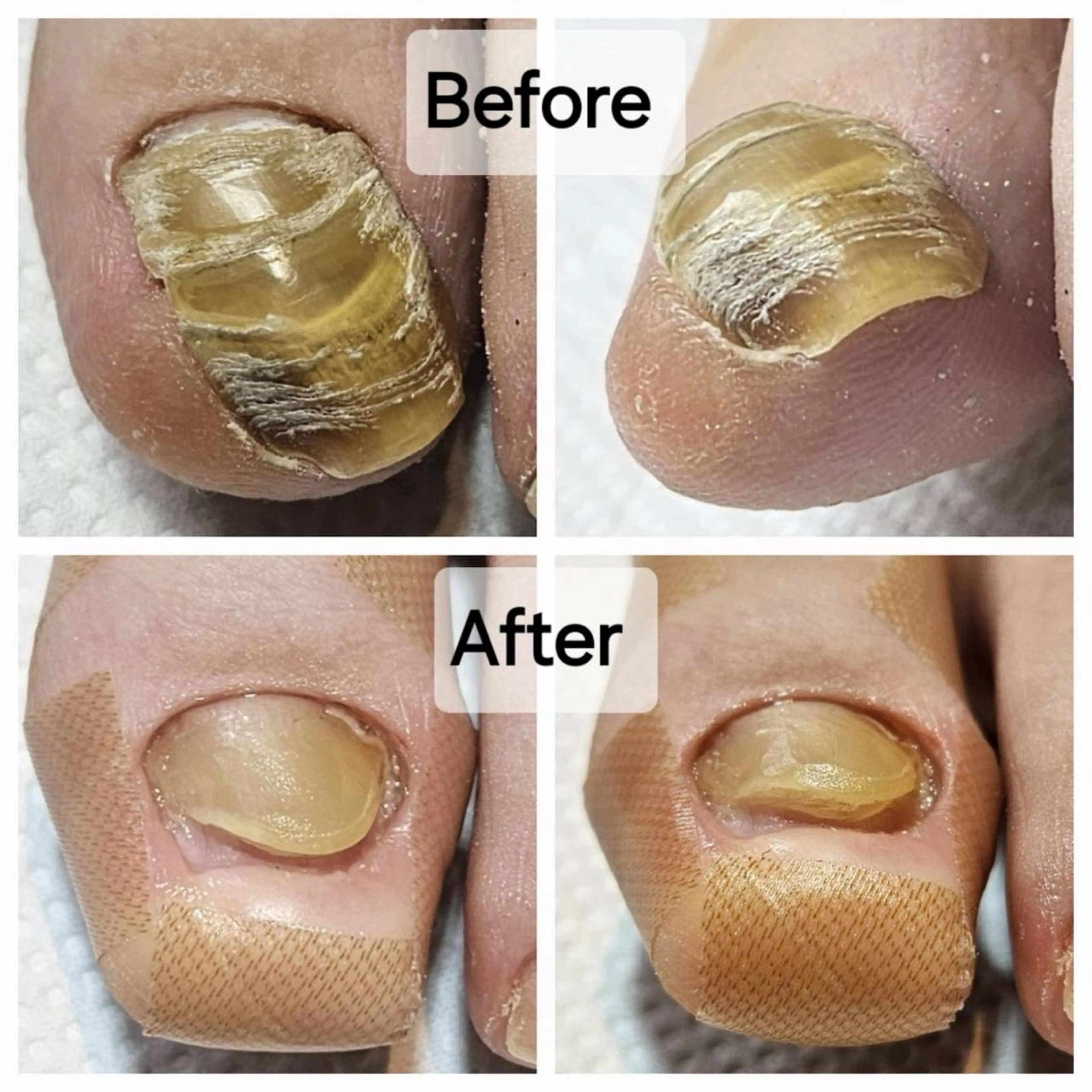 ネイル 深爪・巻き爪 専門サンセリテのネイルデザイン