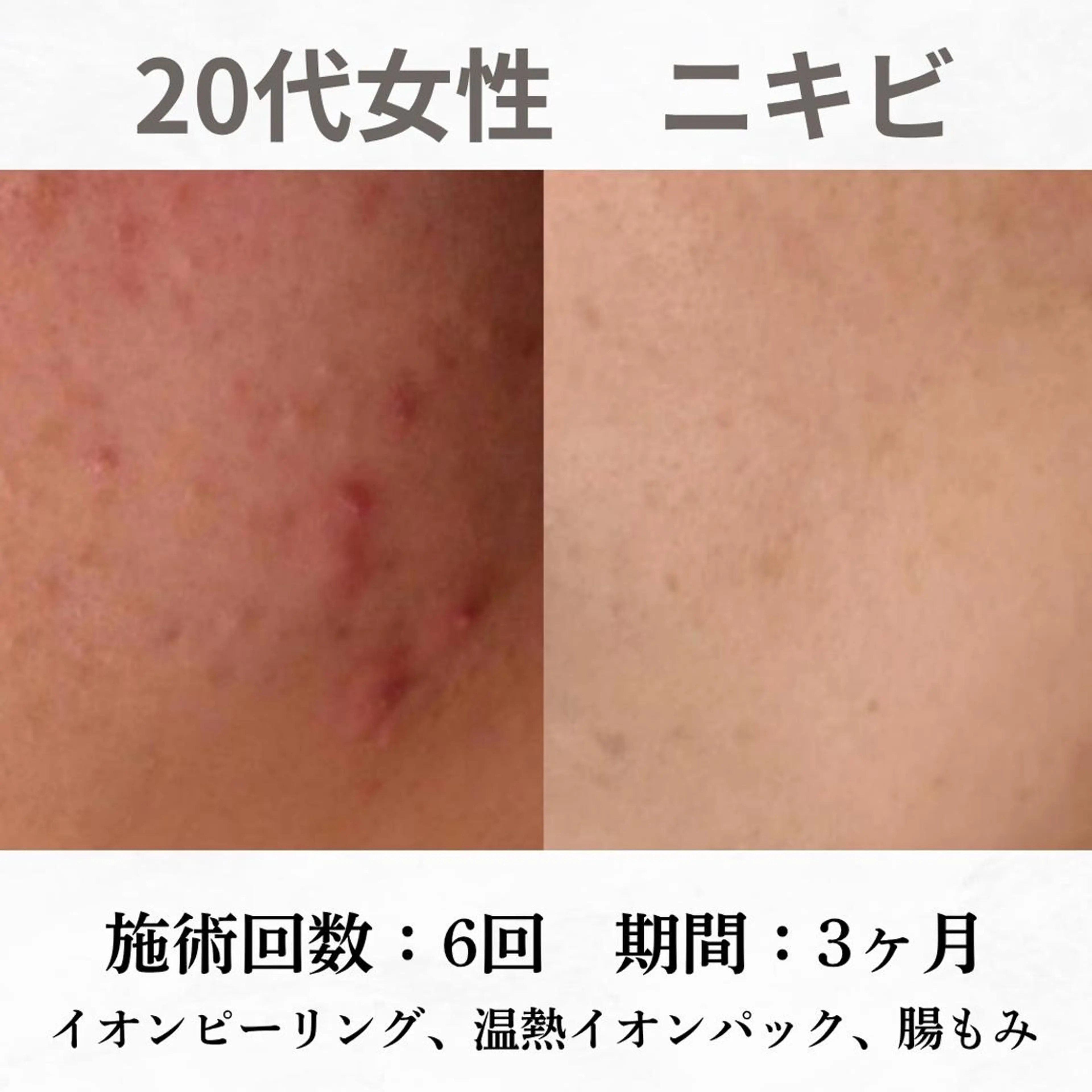 重度ニキビ専門🌷 ダウンタイムなしのエステ・リラクイメージ