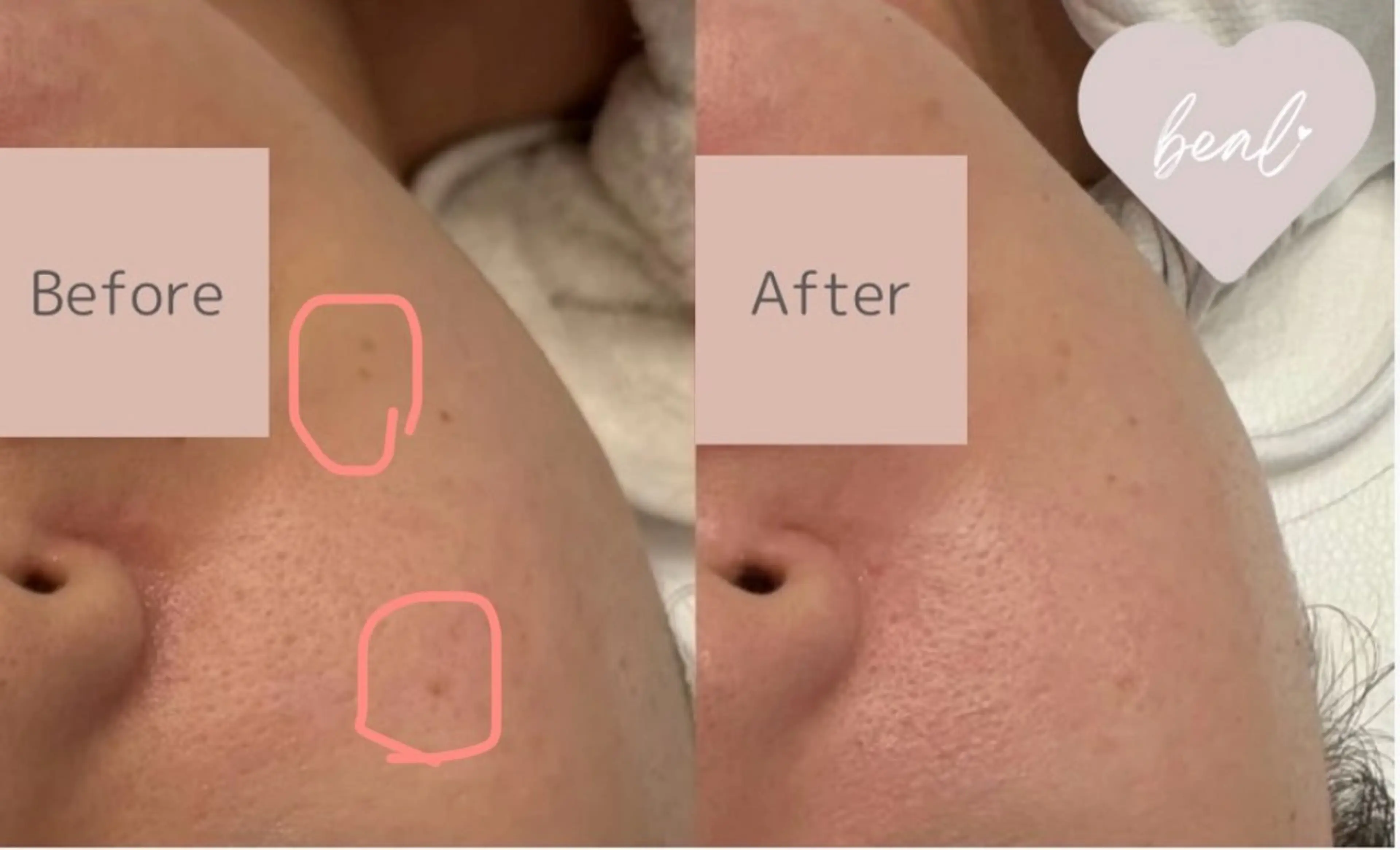 べアール所属・小顔/毛穴/ニキビ salon bealのエステ・リラクイメージ