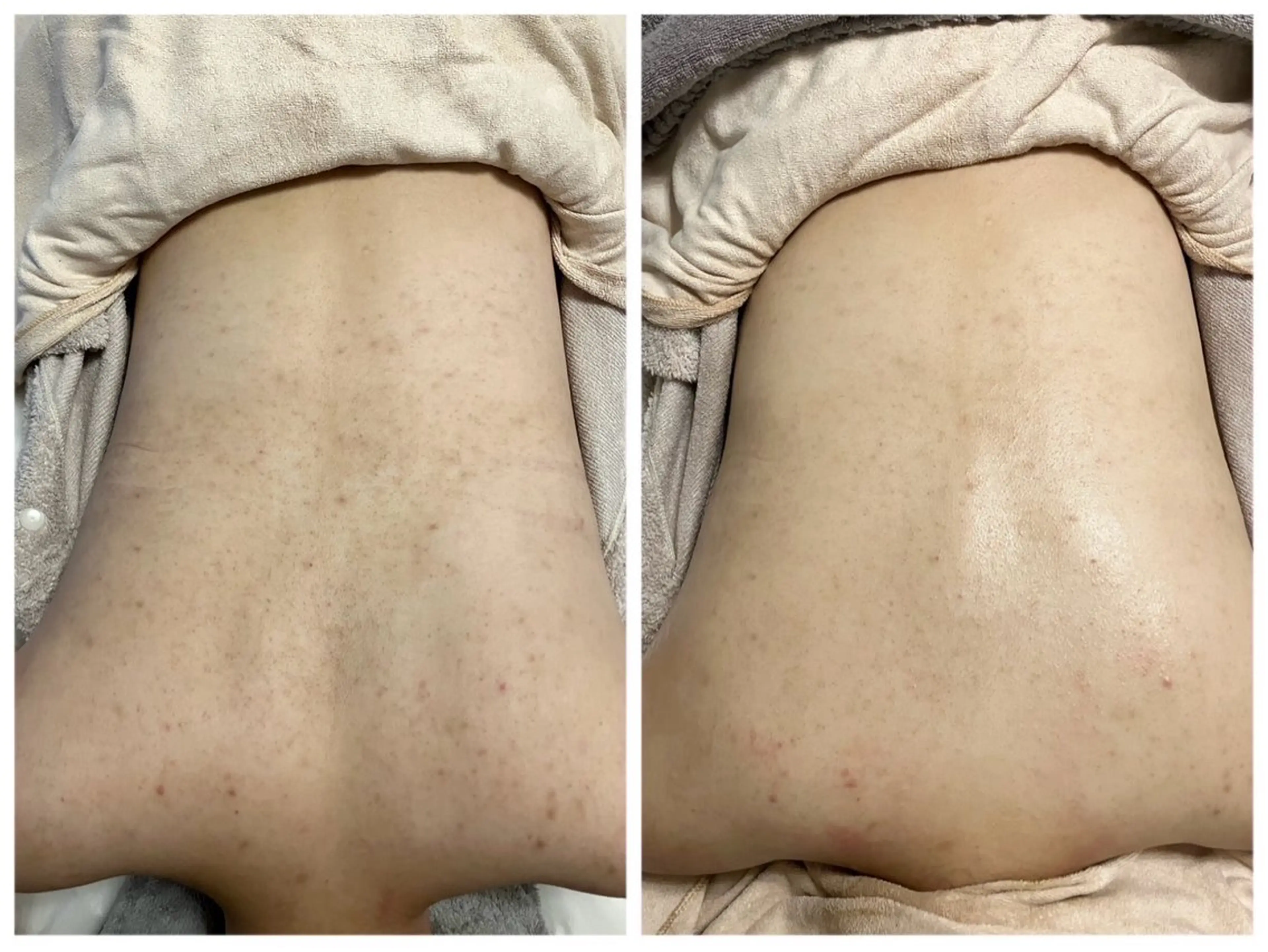 肌質改善ハーブトリートメント🌿【国産ハーブ✖️ドクターズライン】肌タイプを選ばない【お背中】上半分or下半分の写真