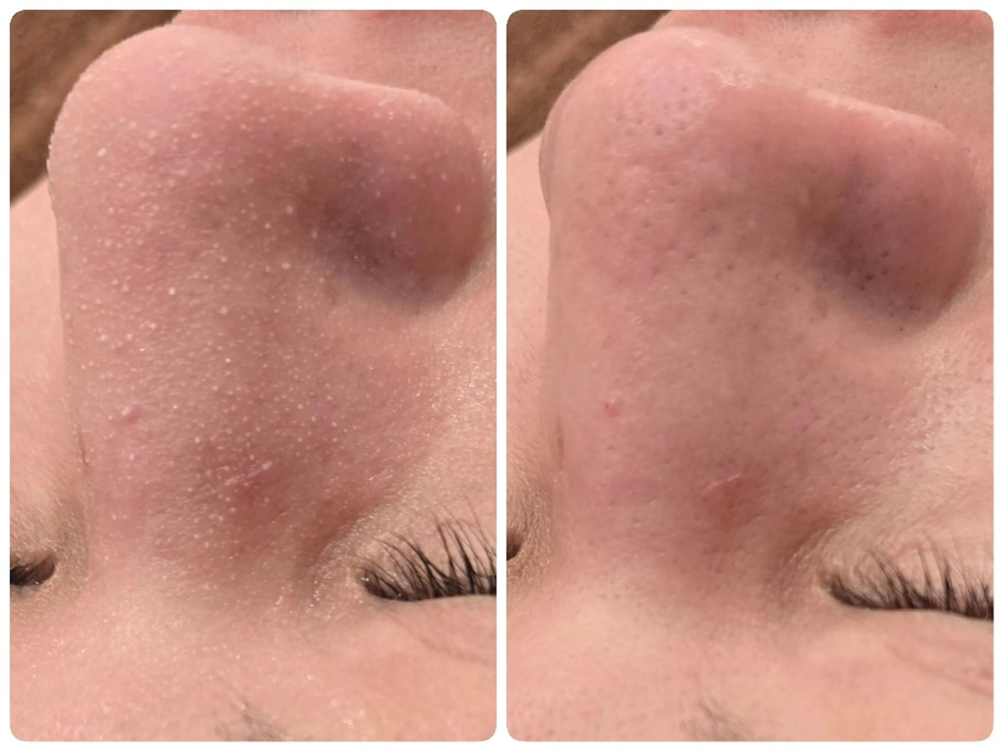 【ごっそり毛穴ケア】周南市初上陸！韓国式3D毛穴洗浄の写真