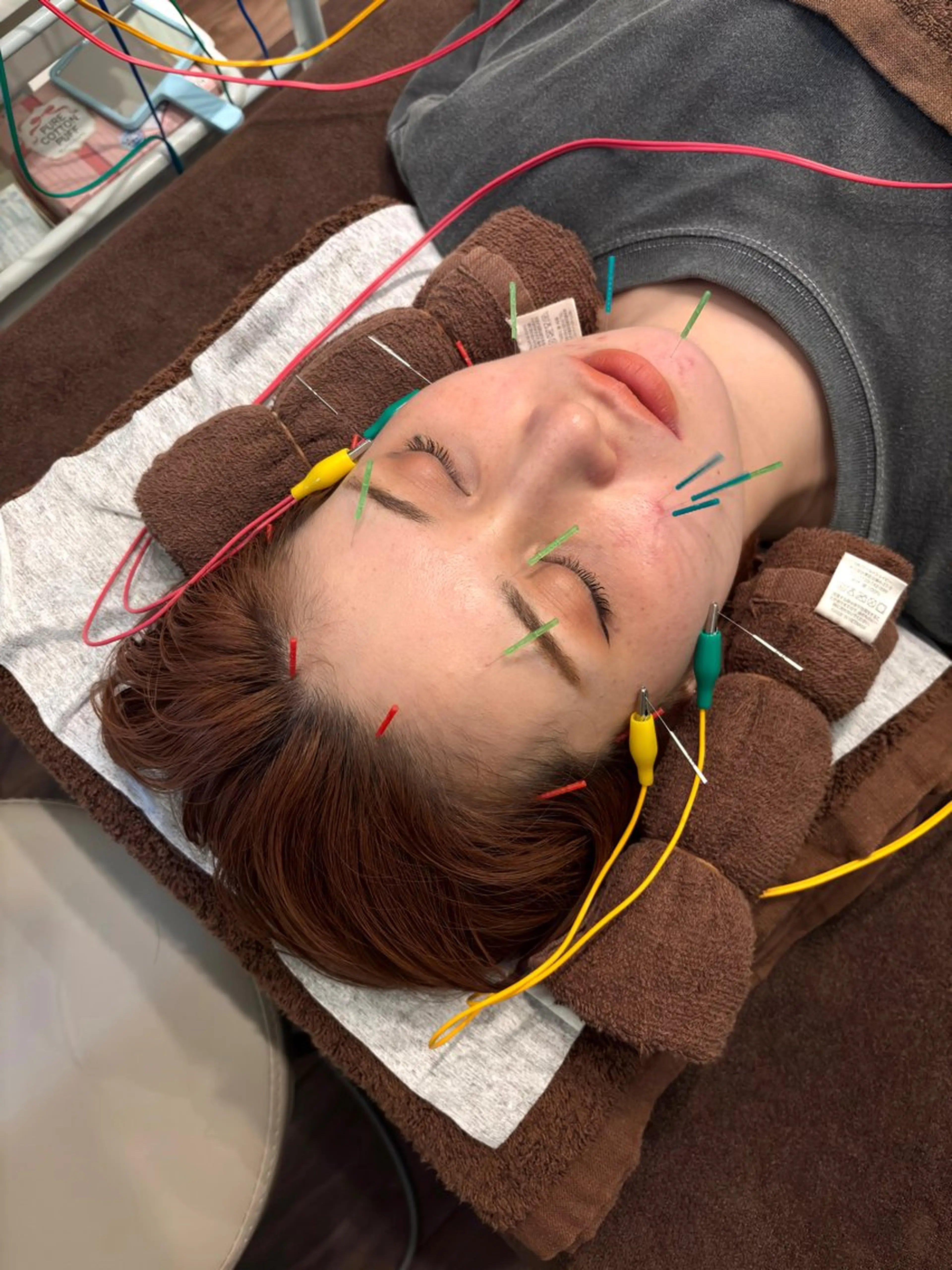 【シュッと✨ﾌｪｲｽﾗｲﾝ形状記憶✨】美容鍼×本質ケア→ フェイスラインのもたつき・むくみ・が気になる方への写真