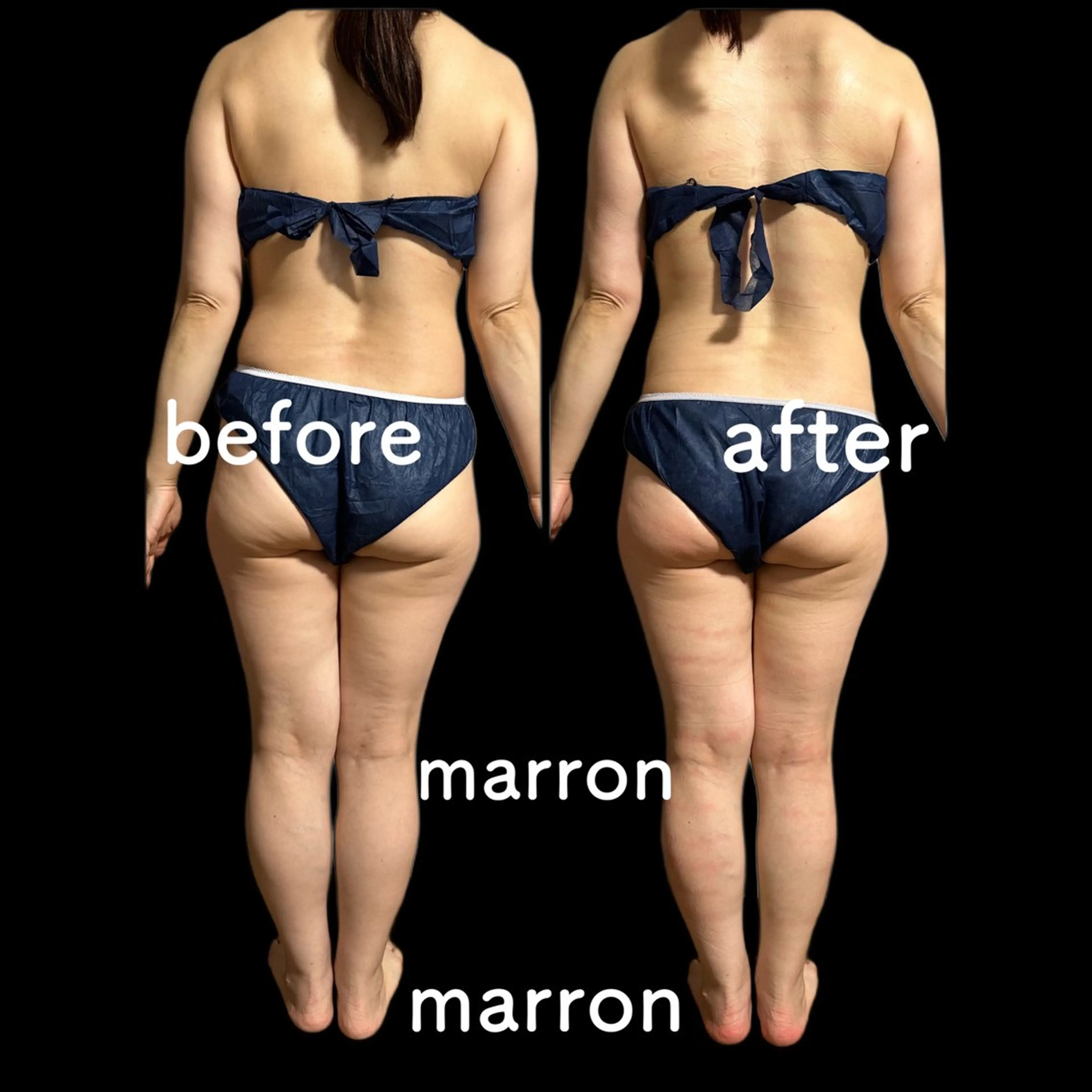 痩身ハイパーナイフ ララピールリアボーテのエステ・リラクイメージ