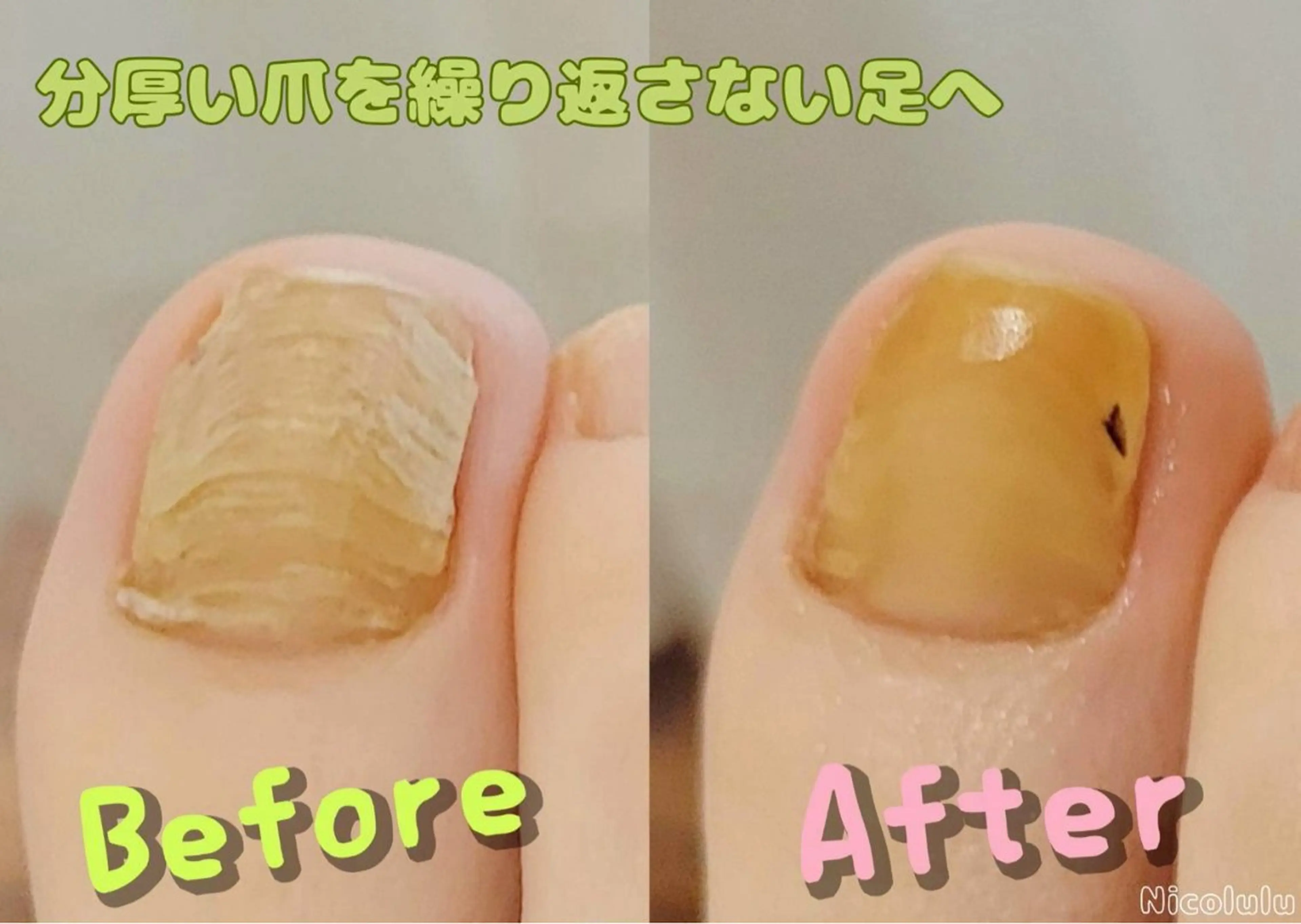 期間限定モニター【分厚い爪！伸びない爪！諦めない！】12800→5000の写真