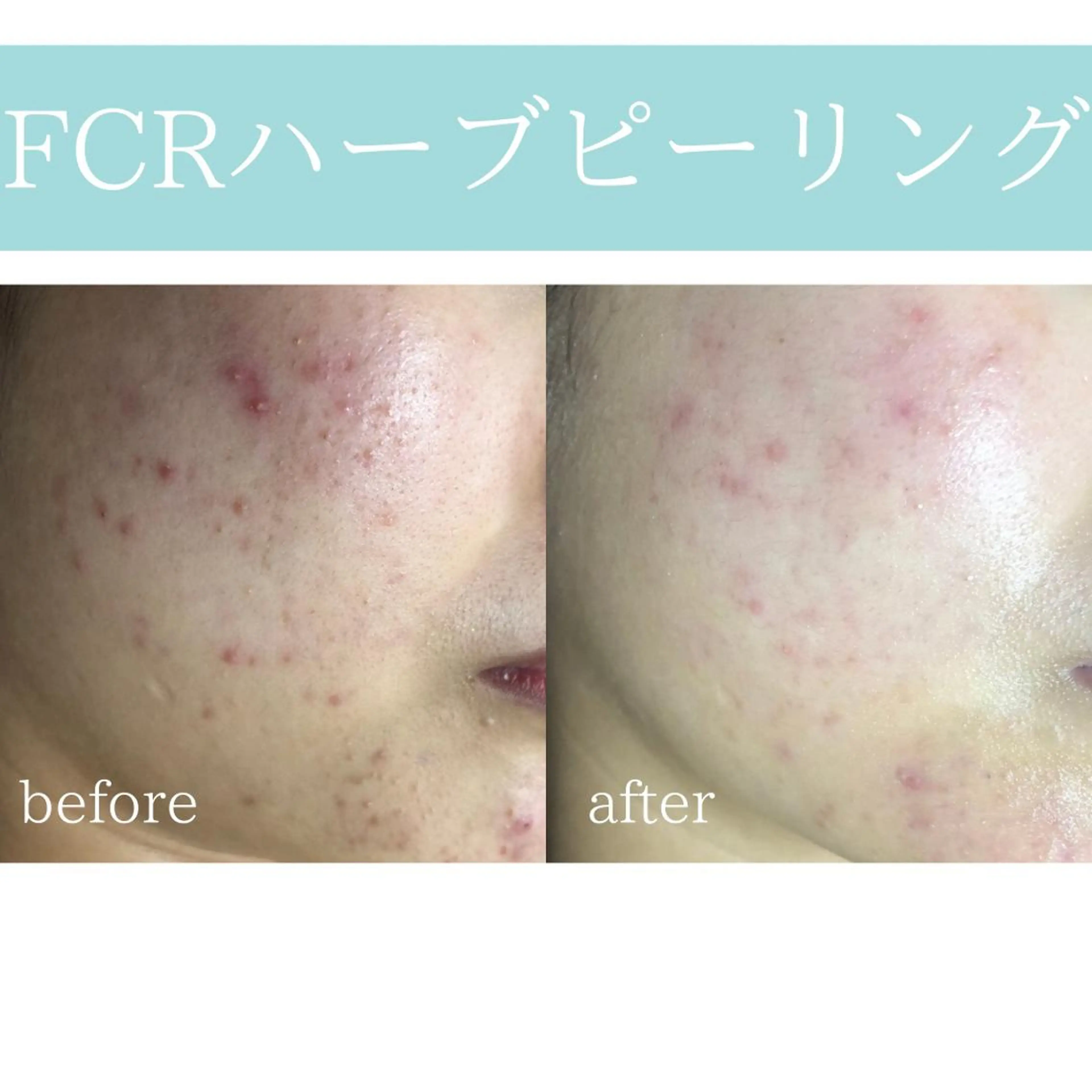 心斎橋痩身ダイエット 韓国.美容鍼.小顔のエステ・リラクイメージ