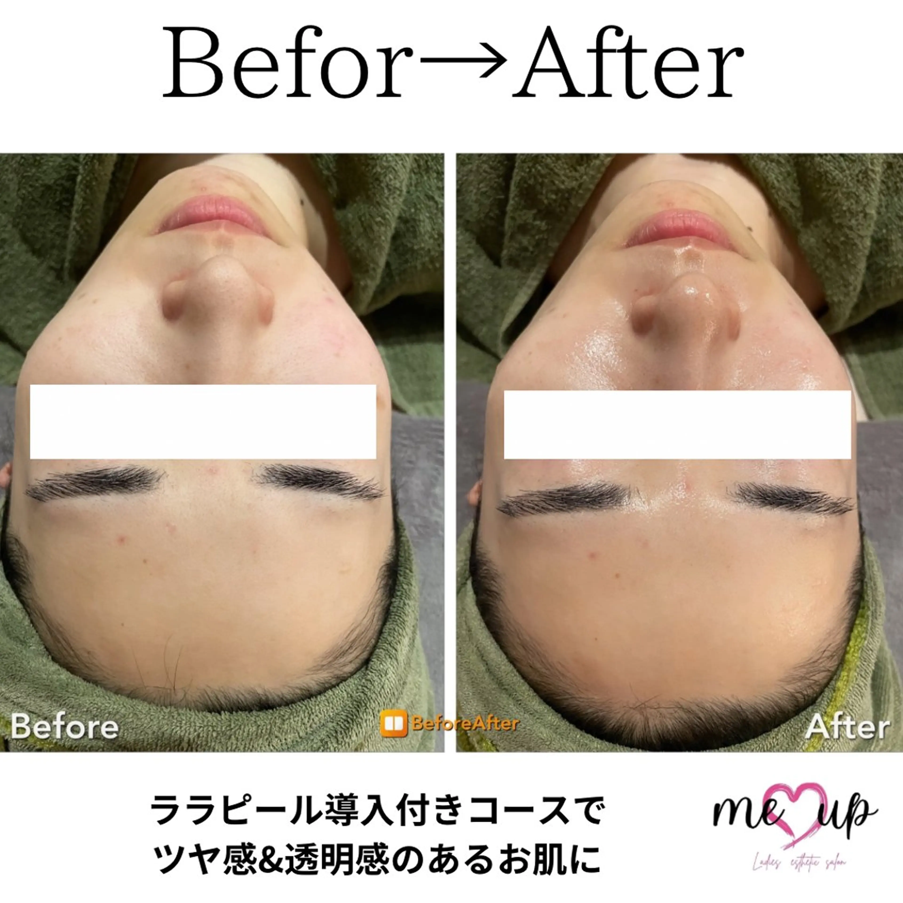 エステ Meupニキビ専門店 背中/ハーブ/肌管理のその他イメージ