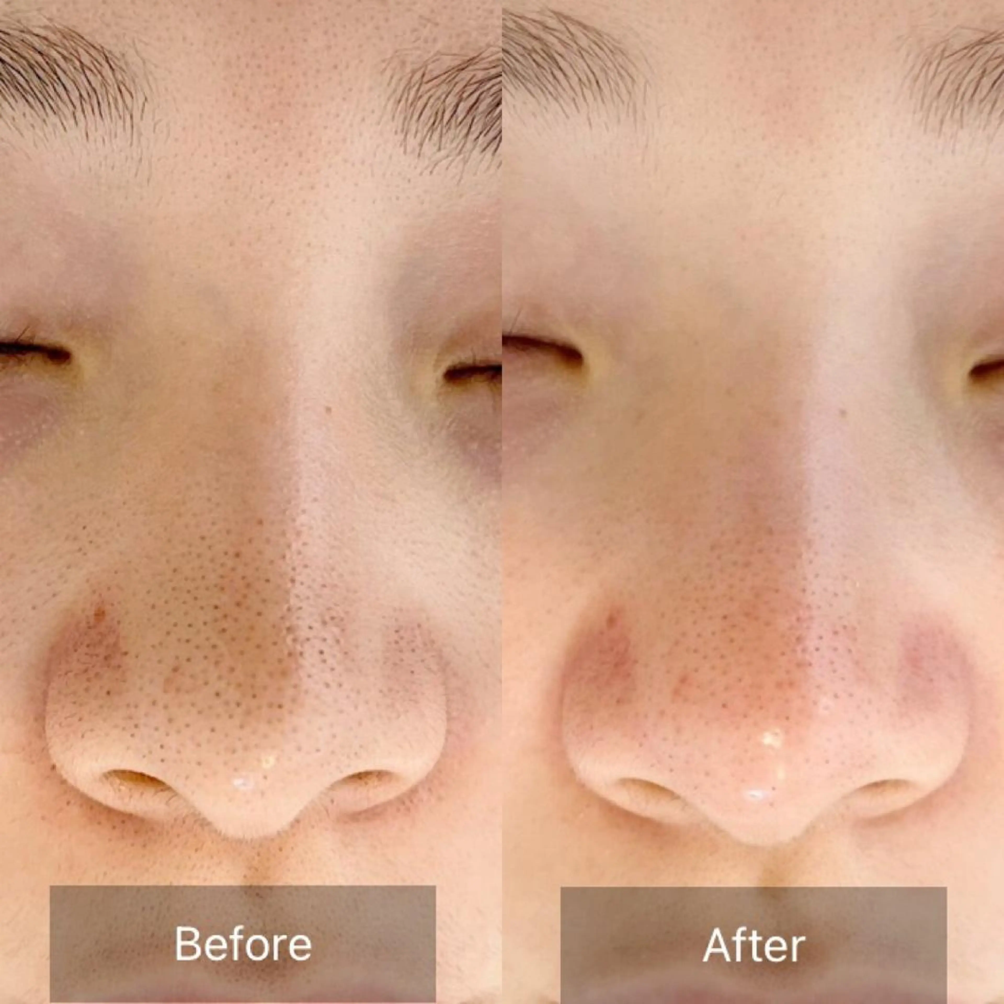 毛穴エクストラクション90分フルコース✨の写真