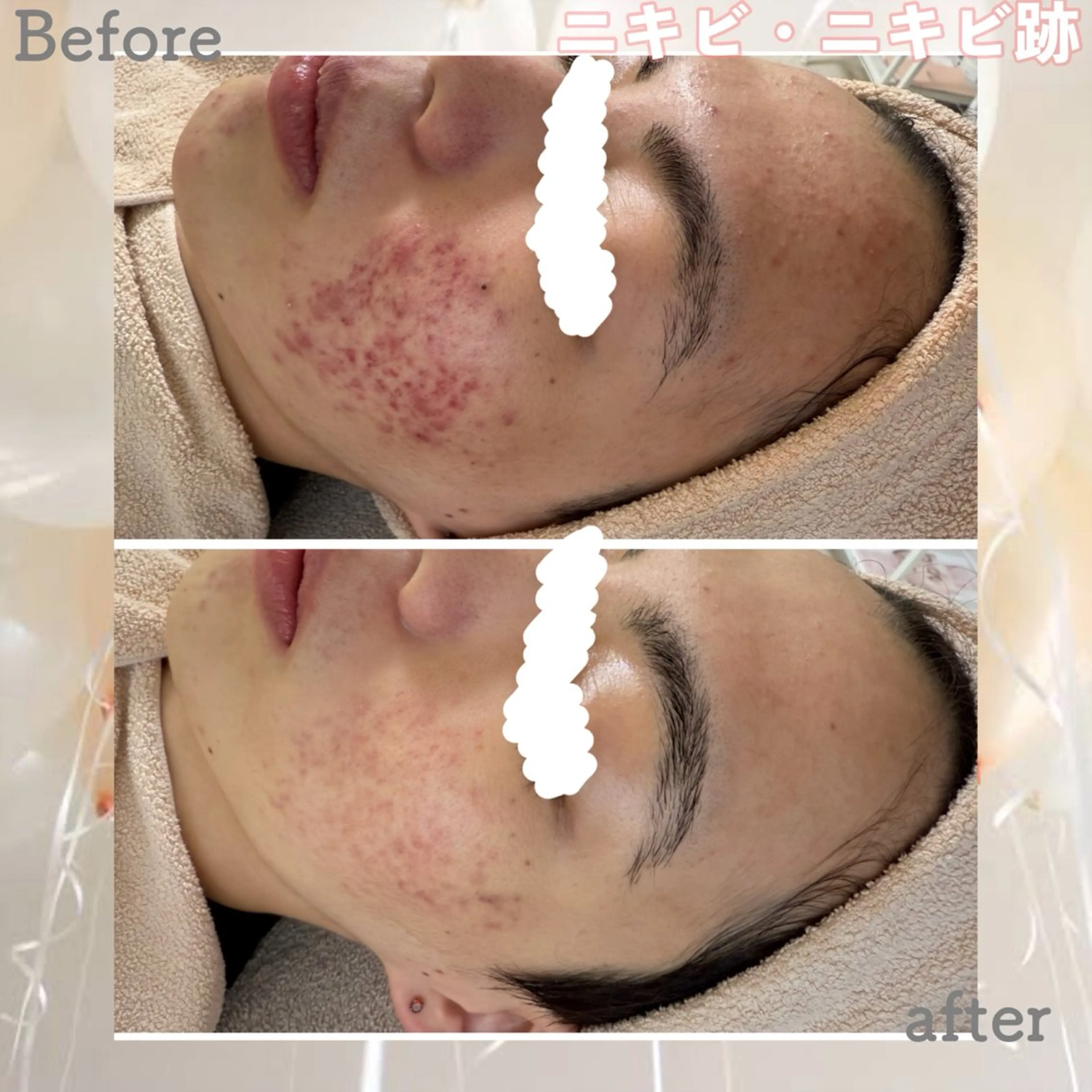 エステ ニキビ&跡改善サロン オーナー光木のエステ・リラクイメージ