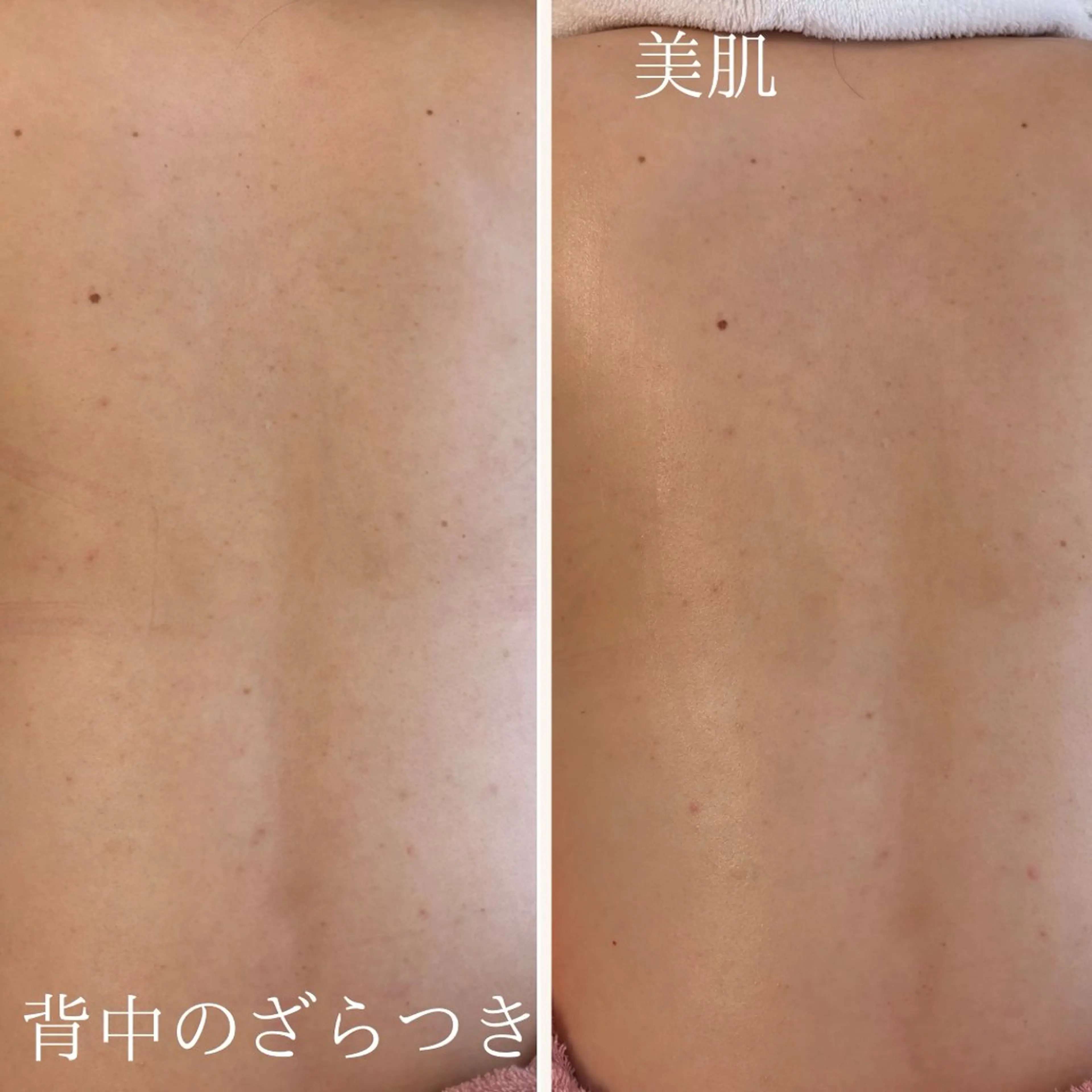 ＼夏に向けて背中美人に！背中集中ケア／ざらつき・ニキビに◎背中ピーリング+美白パック付き¥5,500の写真