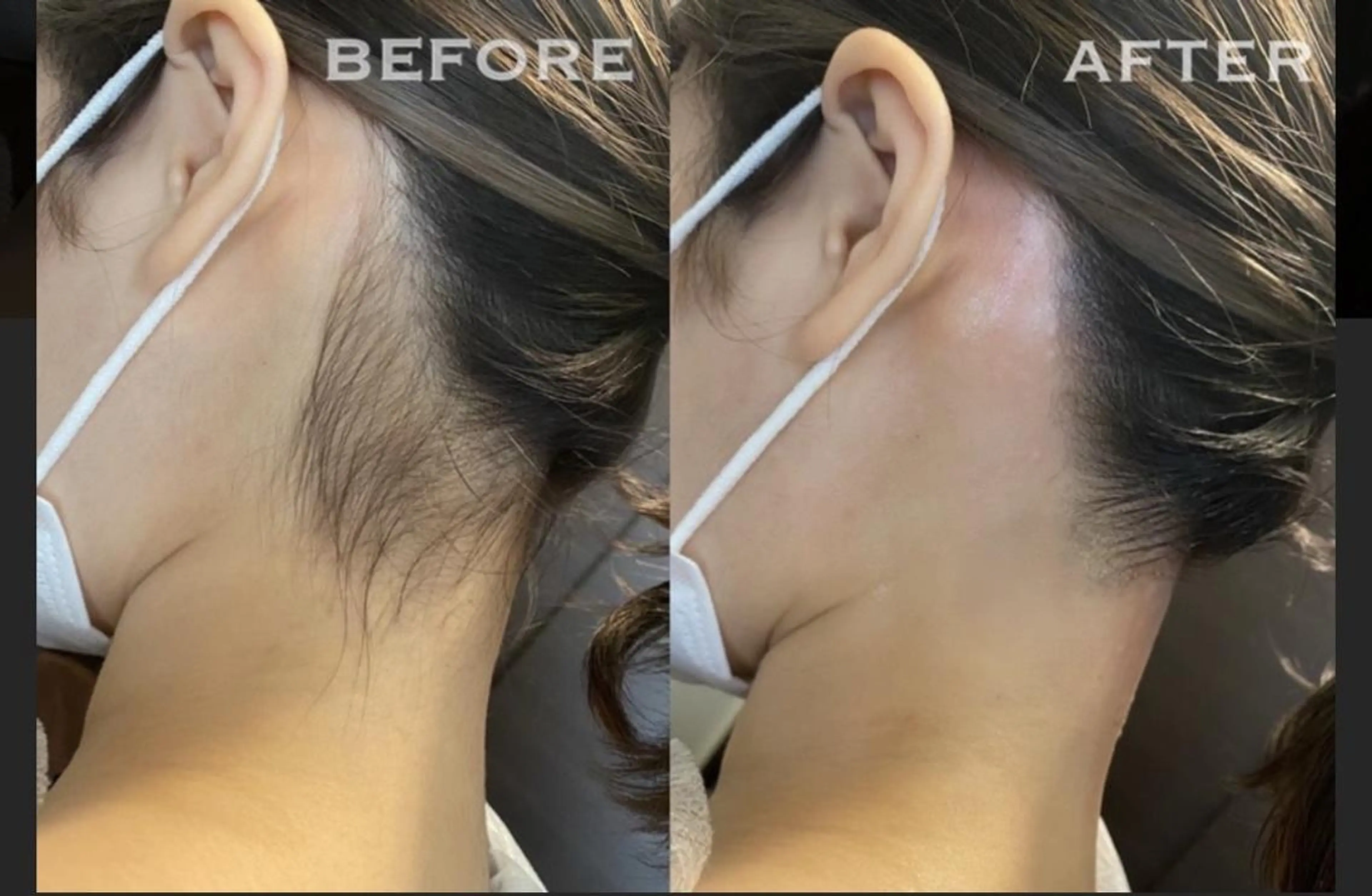 【女性全員】うなじワックス脱毛の写真