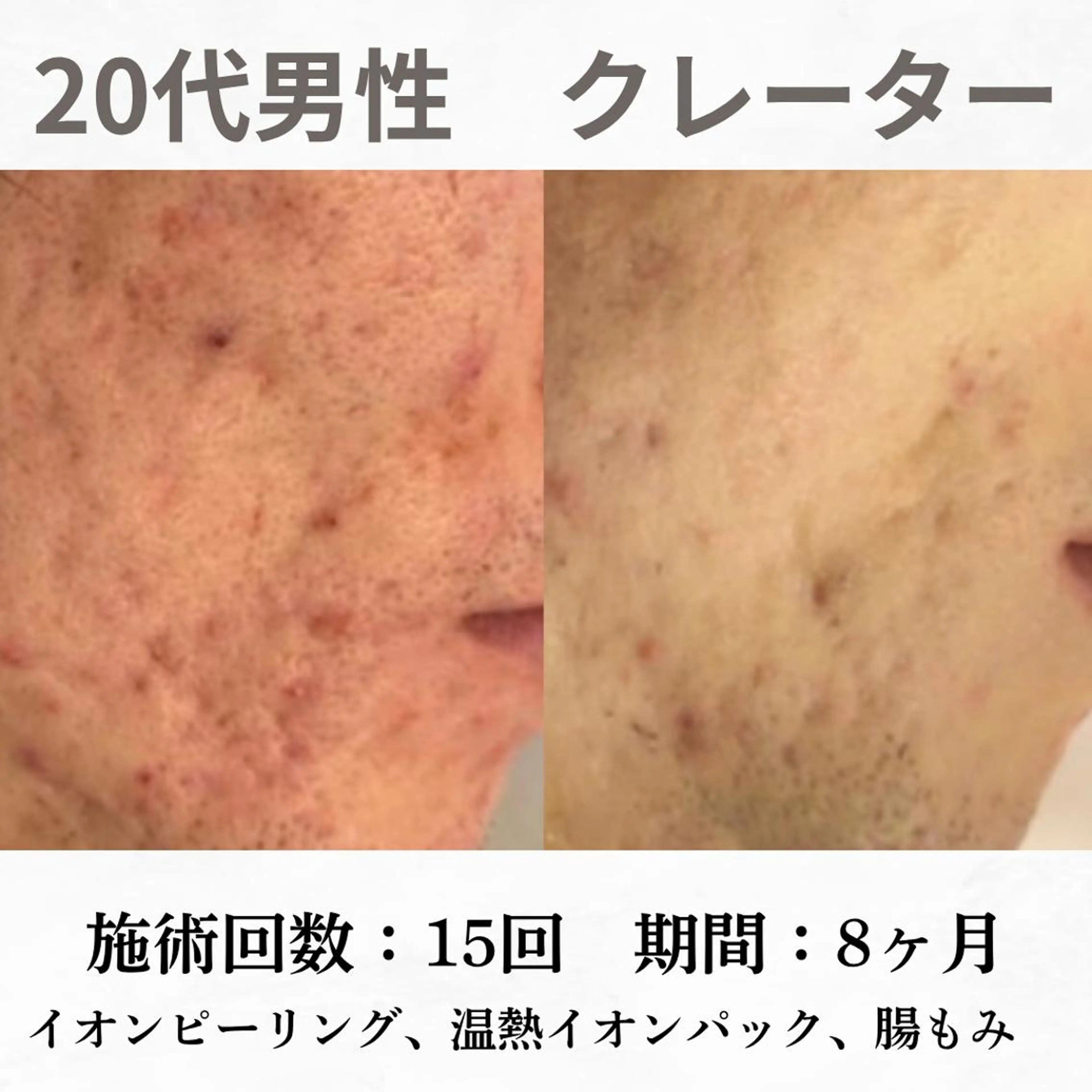 重度ニキビ専門🌷 ダウンタイムなしのエステ・リラクイメージ