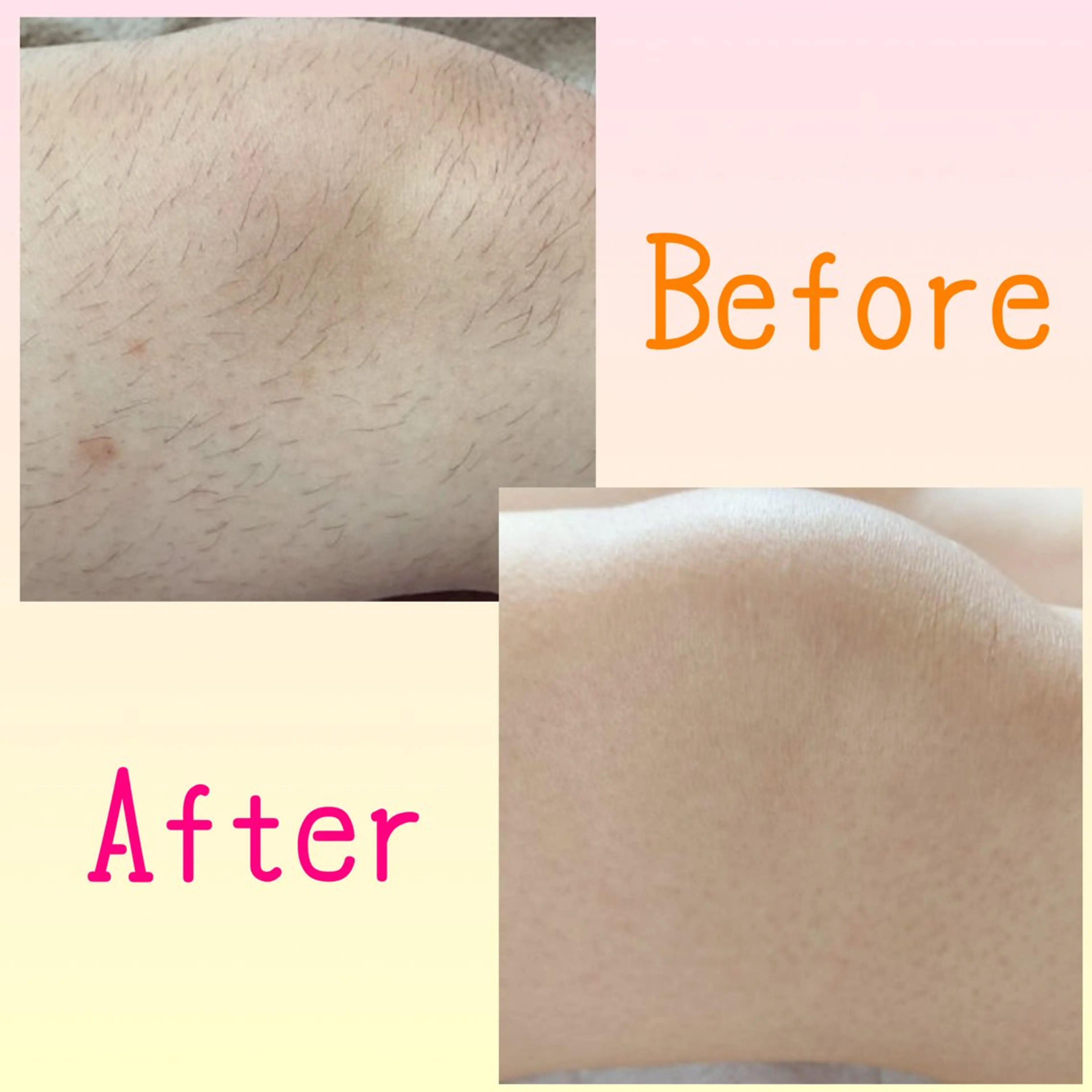 脱毛 Lea Makana-レアマカナ所属・毛穴洗浄🍀脱毛🍀 光フェイシャル🍀のエステ・リラクイメージ